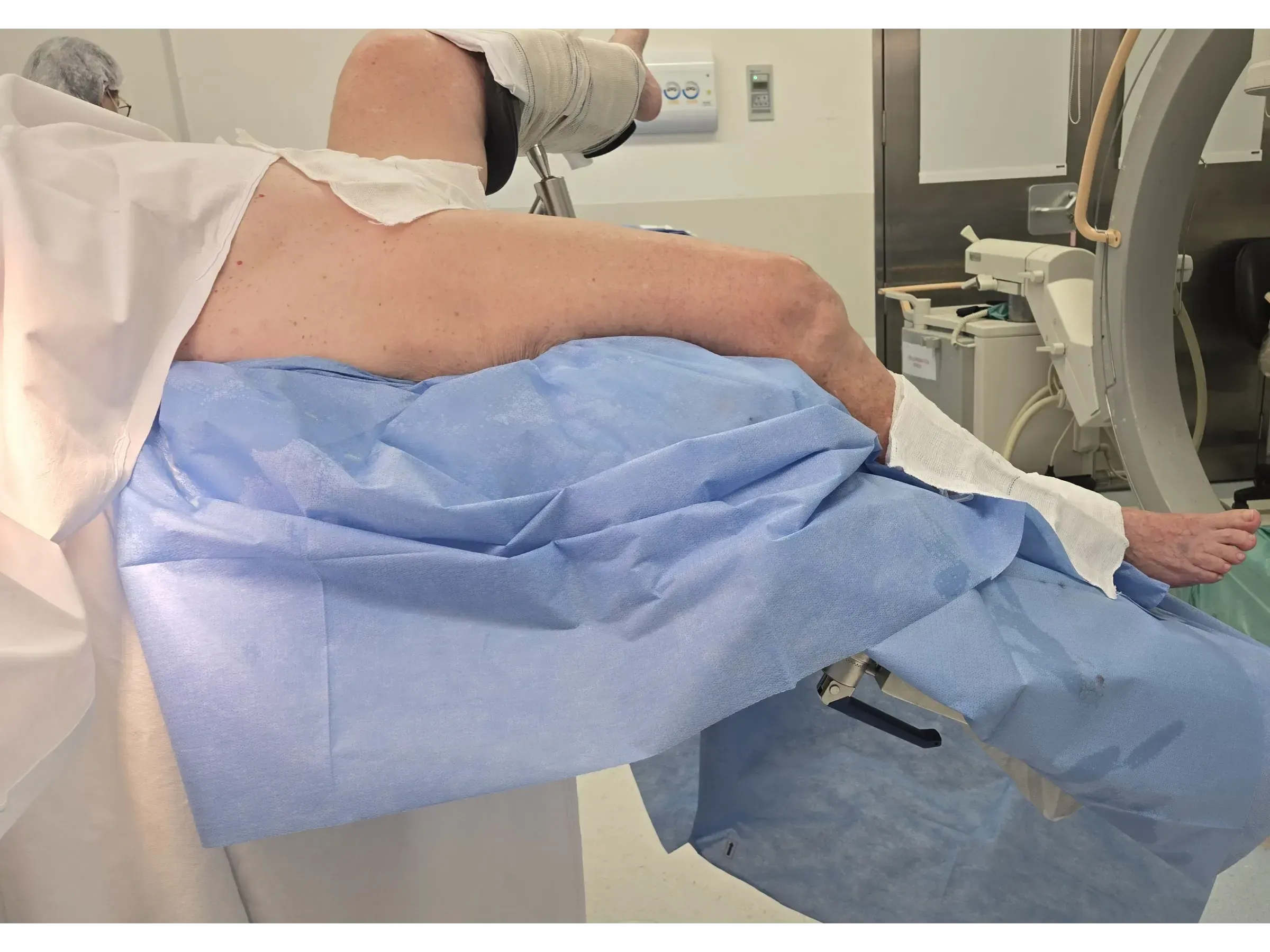 FEMORAL SHAFT [Case 2] · Retrograde Intramedullary Nail