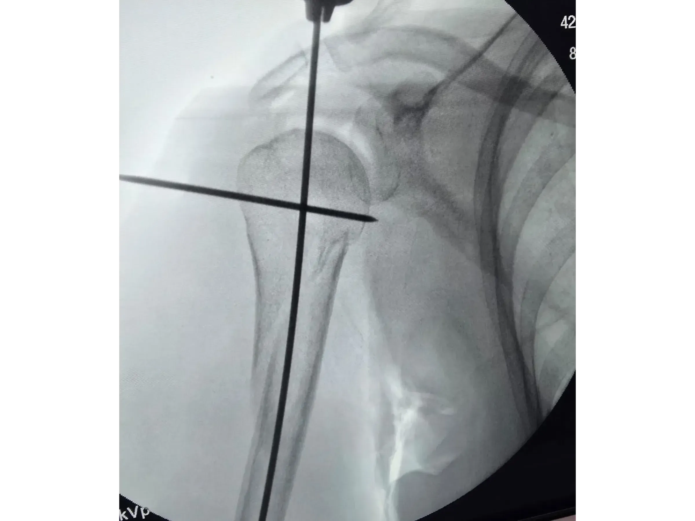 Intramedullärer Nagel für den proximalen Humerus (03)