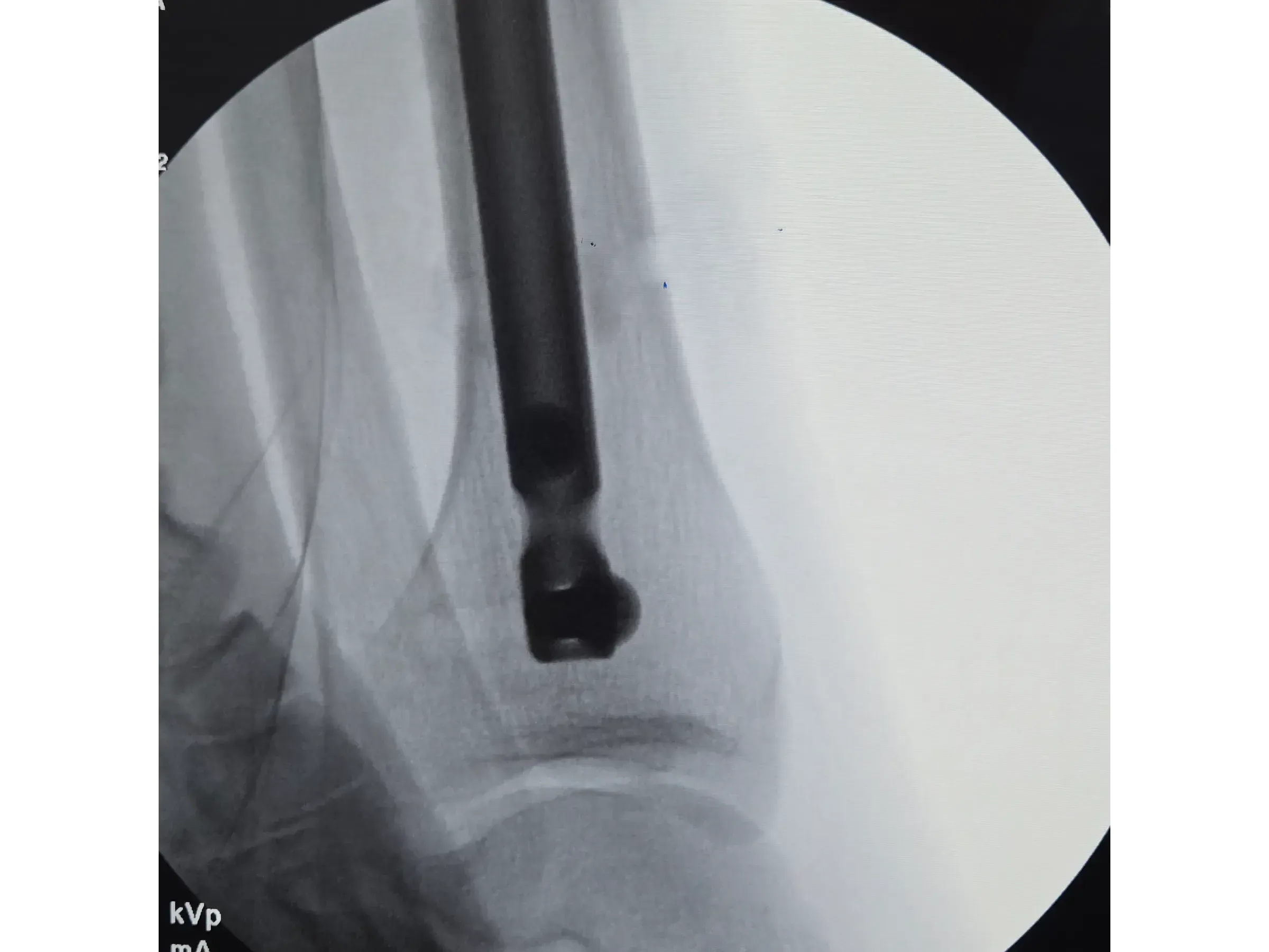 Intramedulläre Tibianagelung – Infrapatellarer Zugang