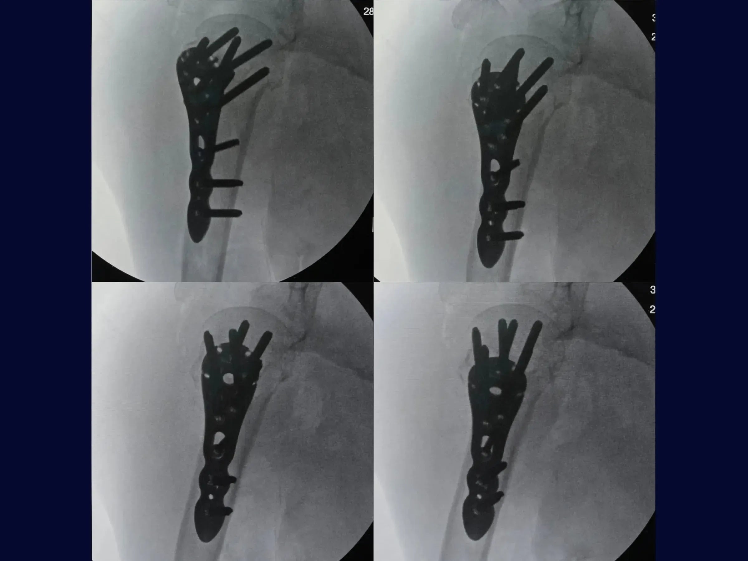 Proximal Humerus – Four-Part Fracture (05)