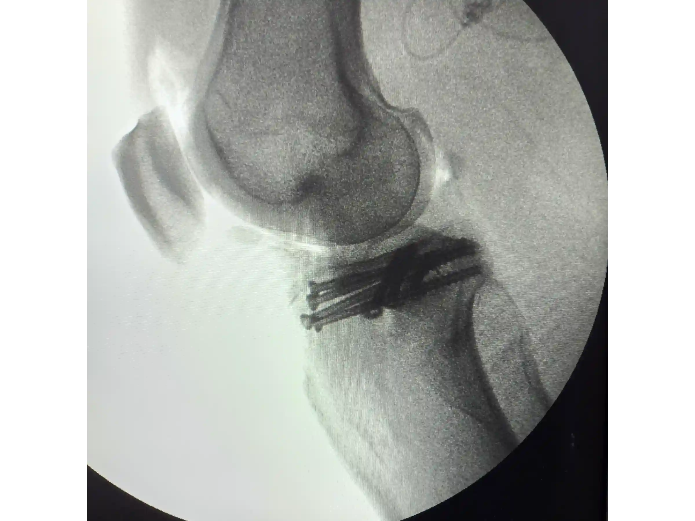 TIBIAL PLATEAU [CASE 03] Posterolateral Depression