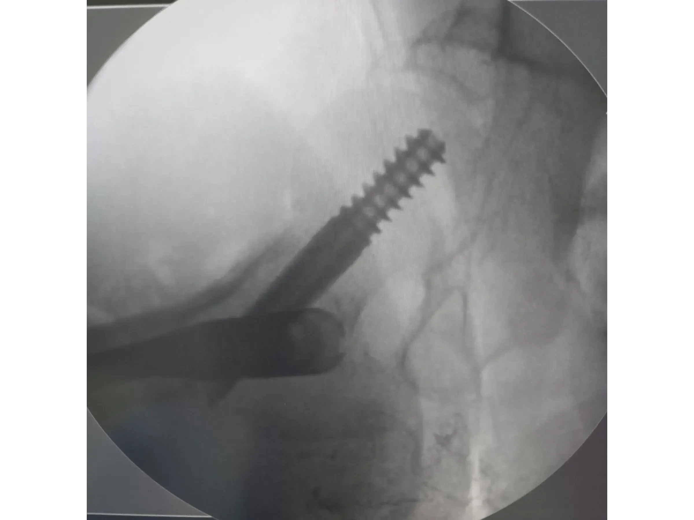 Intramedullärer Nagel für den proximalen Femur 03 – Rocker (Wippen)-Manöver