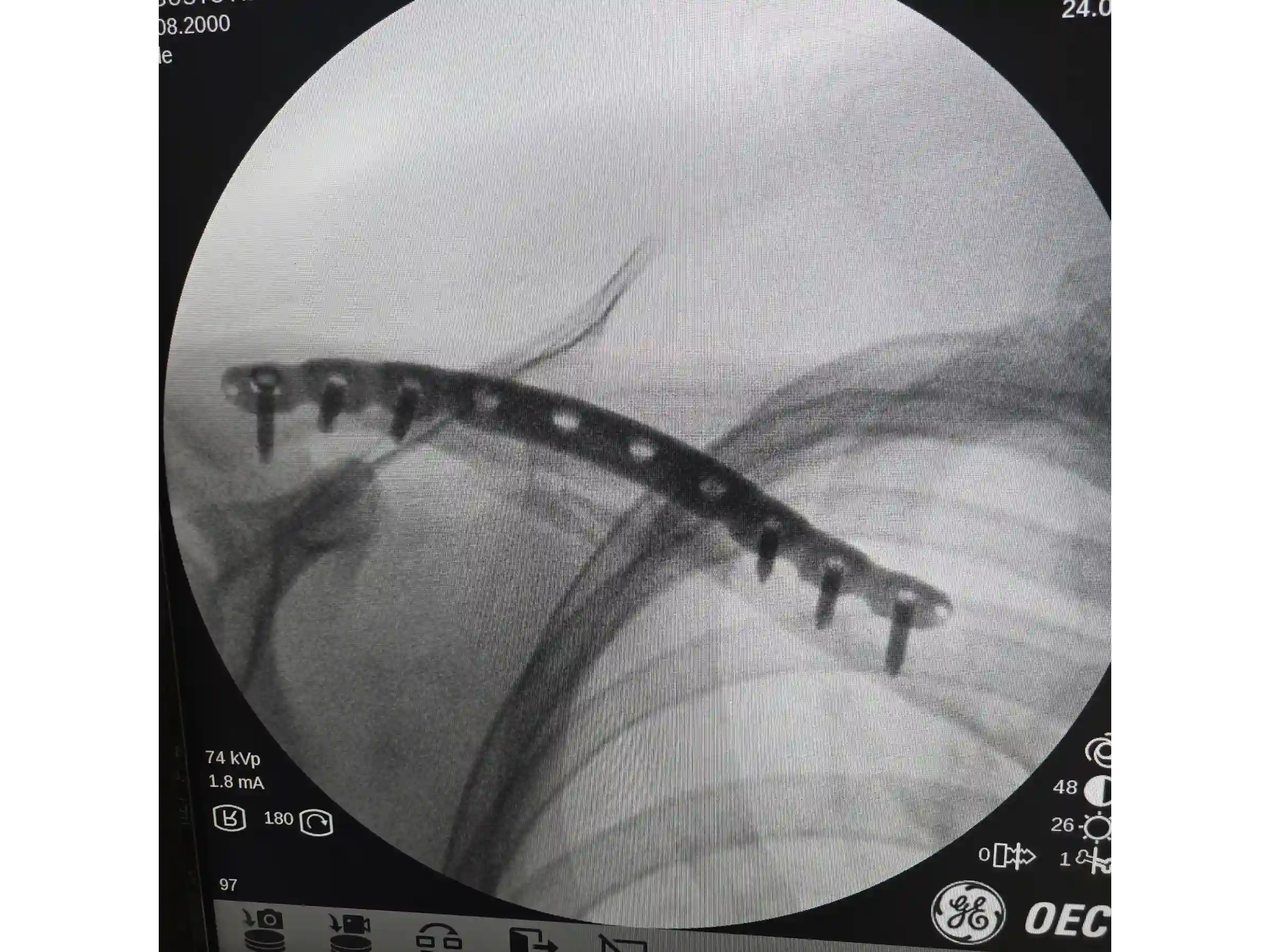 CLAVICLE [CASE 03] Minimally Invasive Percutaneous Osteosynthesis