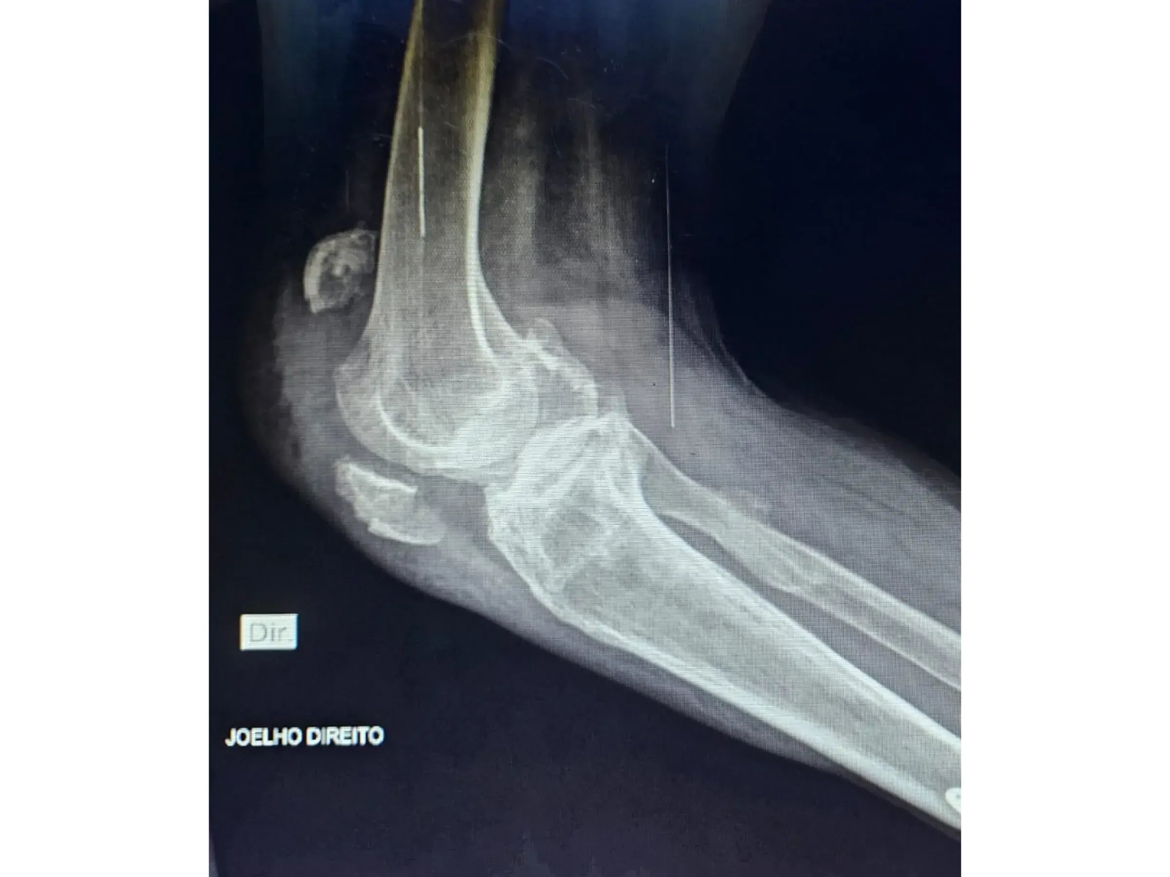 PATELLA [Case 2] · Cannulated Screws + Cerclage