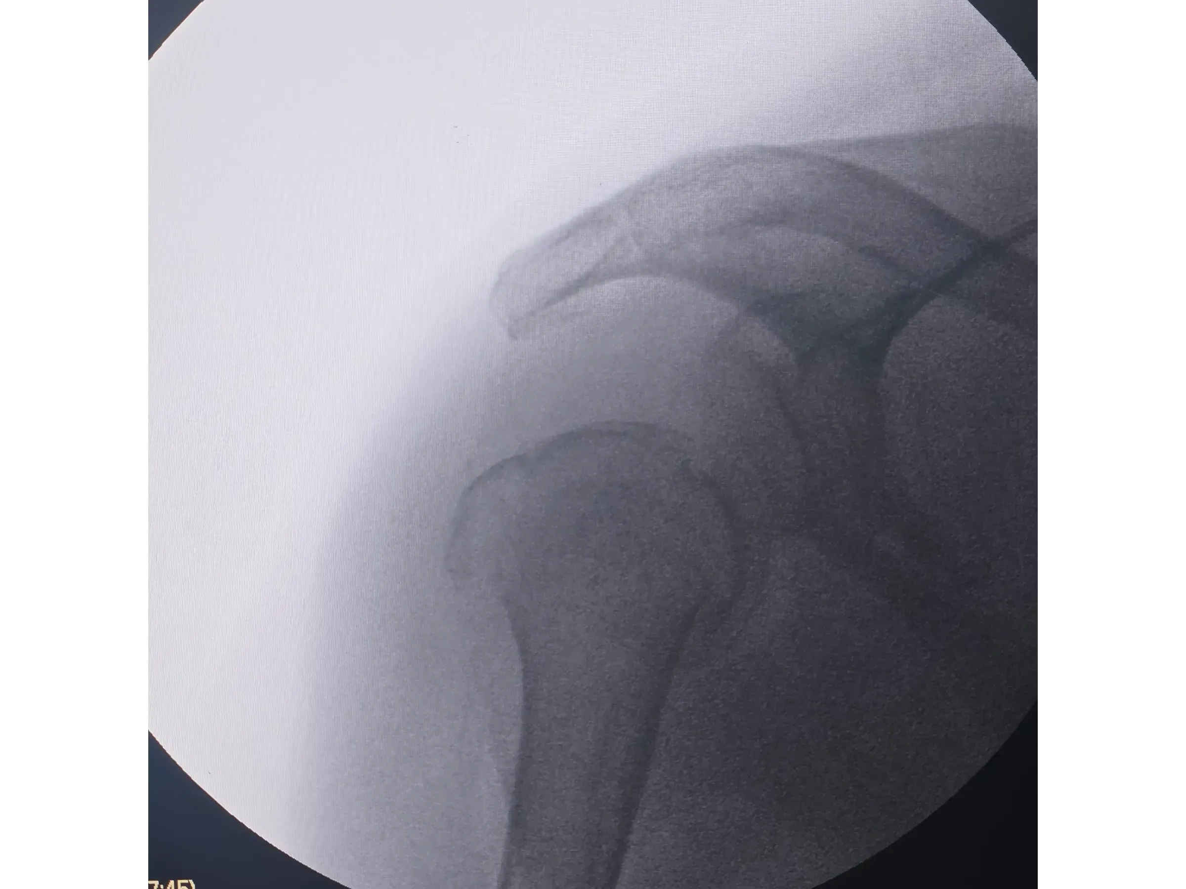PROXIMAL HUMERUS [Case 6] · Two-Part Fracture · Plate and Screws