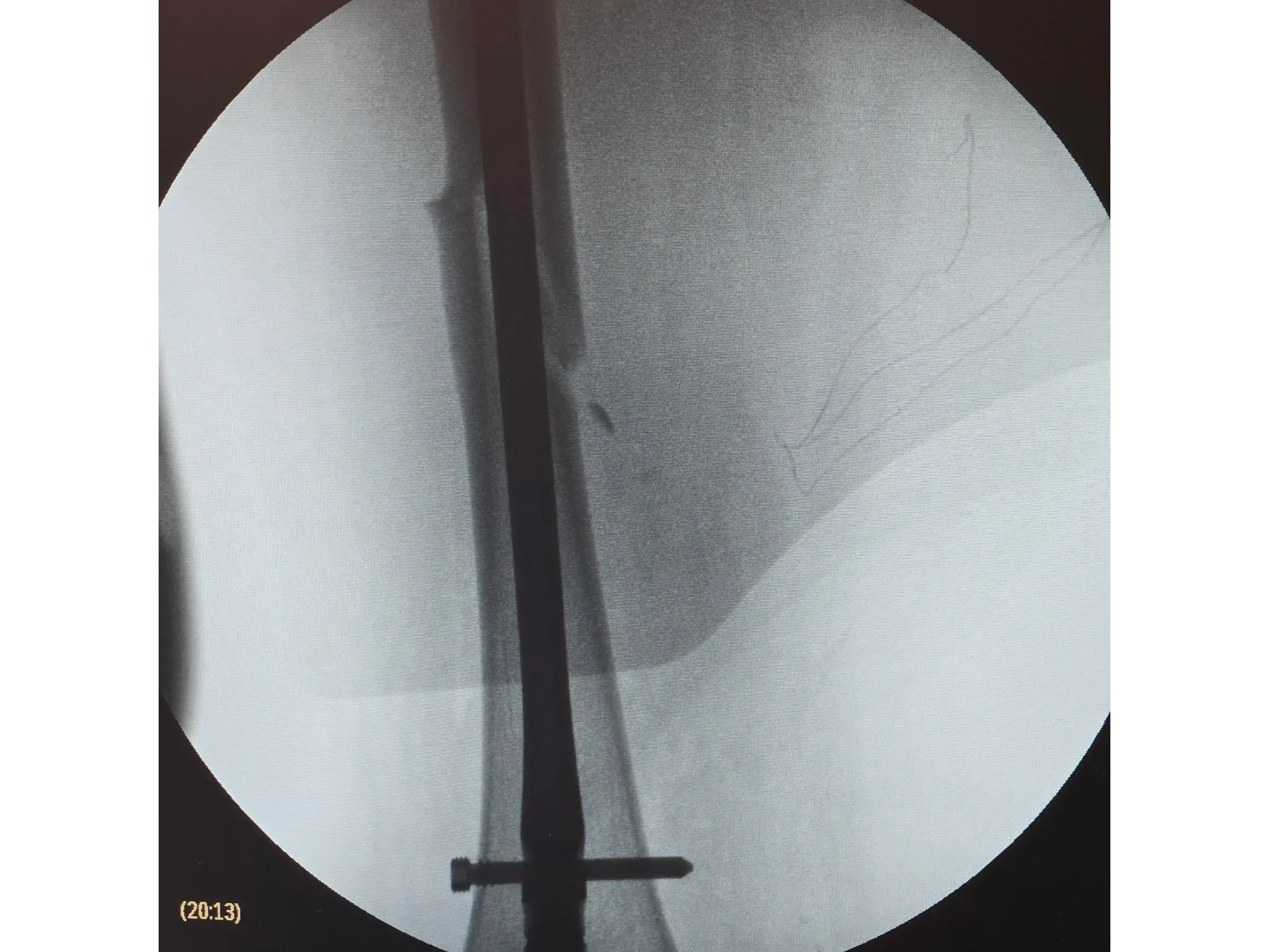 FEMORAL SHAFT [Case 2] · Retrograde Intramedullary Nail