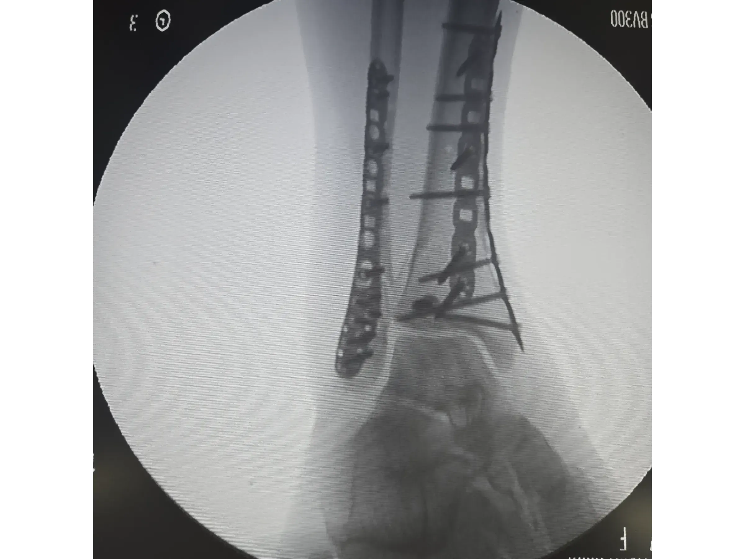 TIBIAL PILON [Case 2] · Posteromedial + Lateral Approach