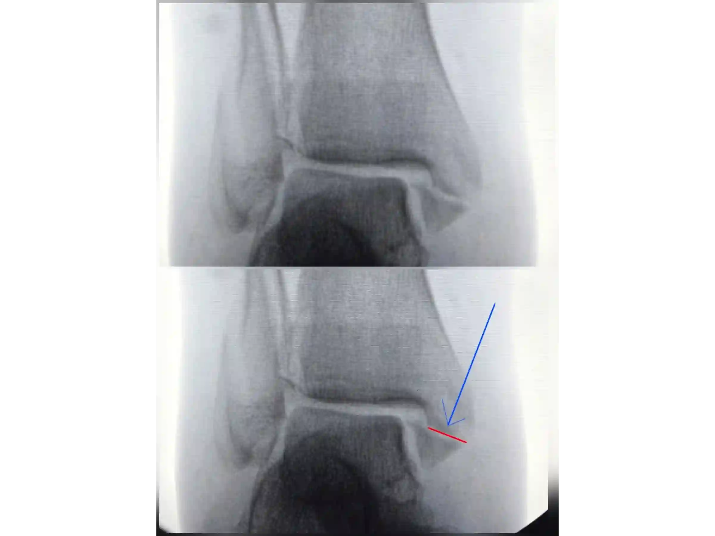 TRIMALLEOLAR [CASE 03] POSTEROLATERAL APPROACH + ANTEGRADE MEDIAL MALLEOLUS FIXATION