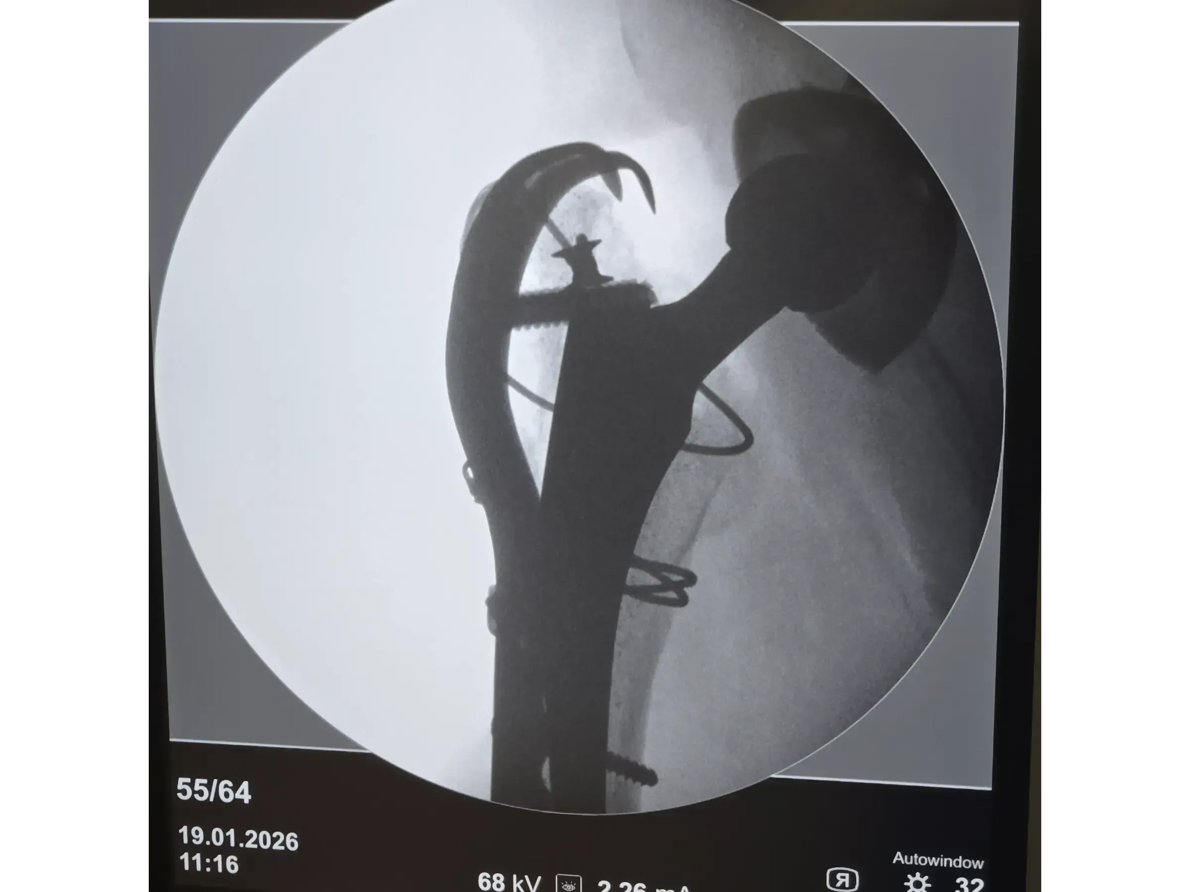 PERIPROSTHETIC HIP FRACTURE [Case 1] · Trochanteric Plate + Cerclage