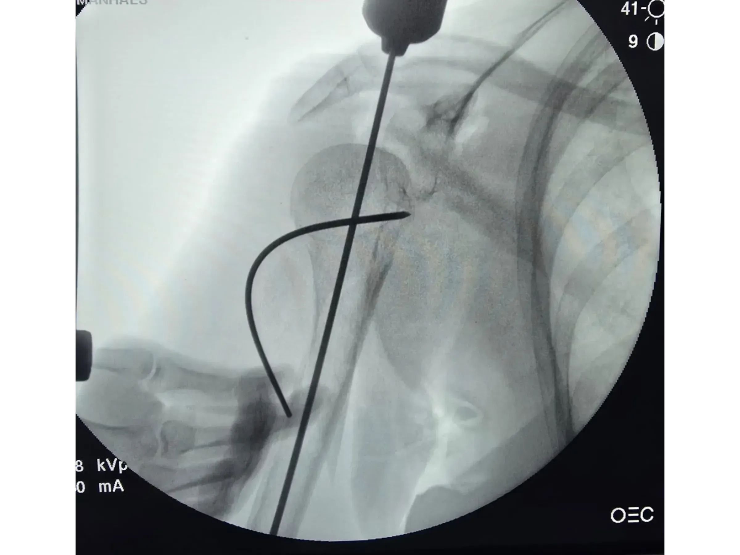 Intramedullärer Nagel für den proximalen Humerus (03)