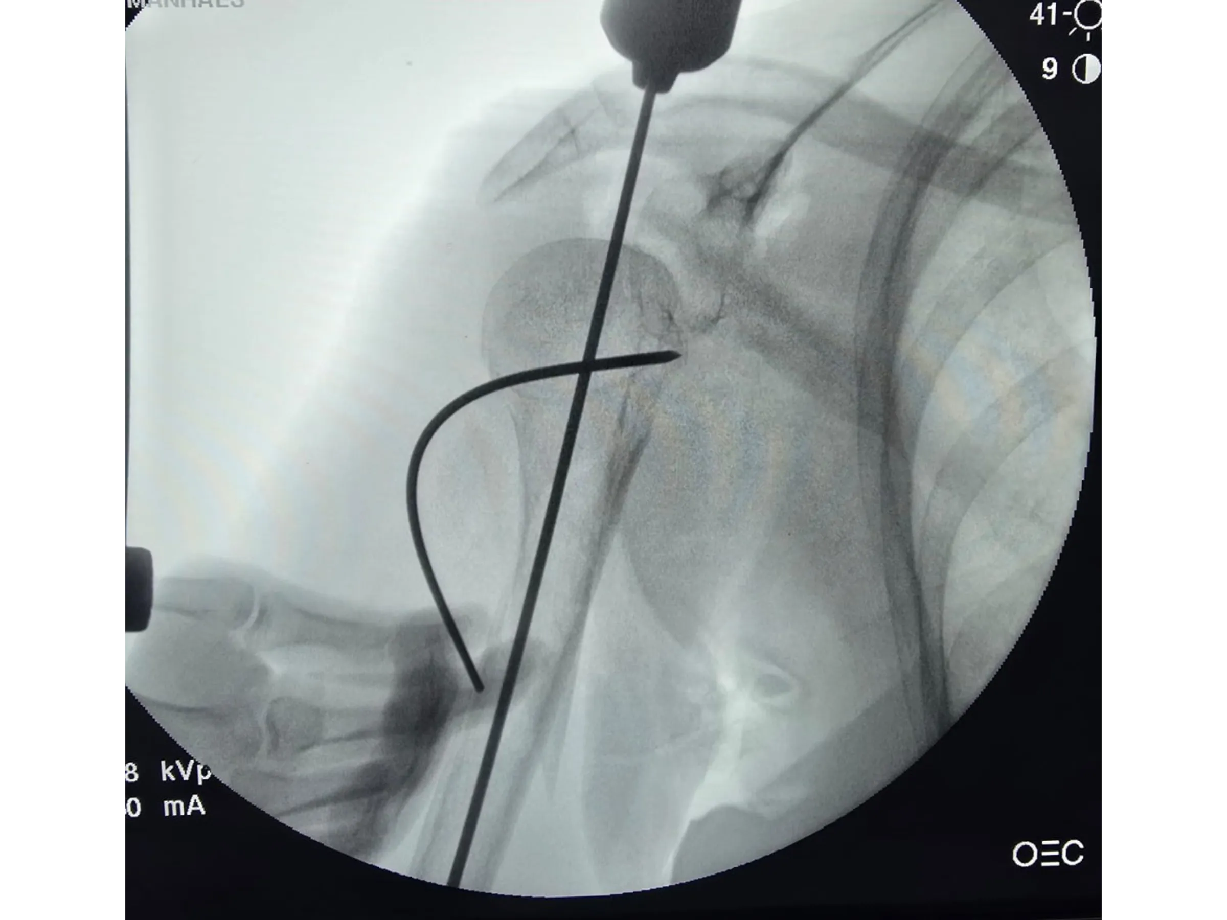Intramedullärer Nagel für den proximalen Humerus