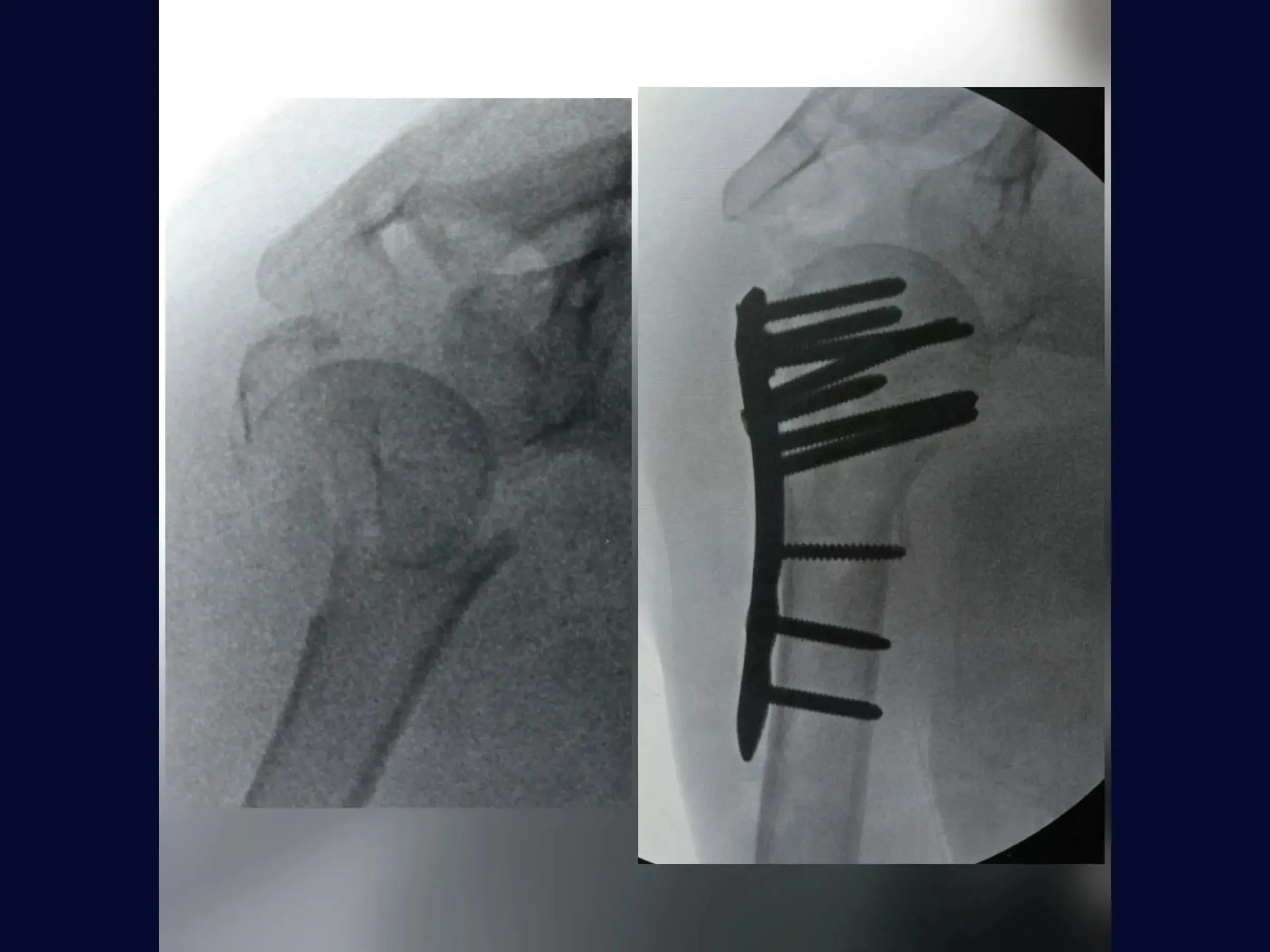 Proximal Humerus – Four-Part Fracture (05)