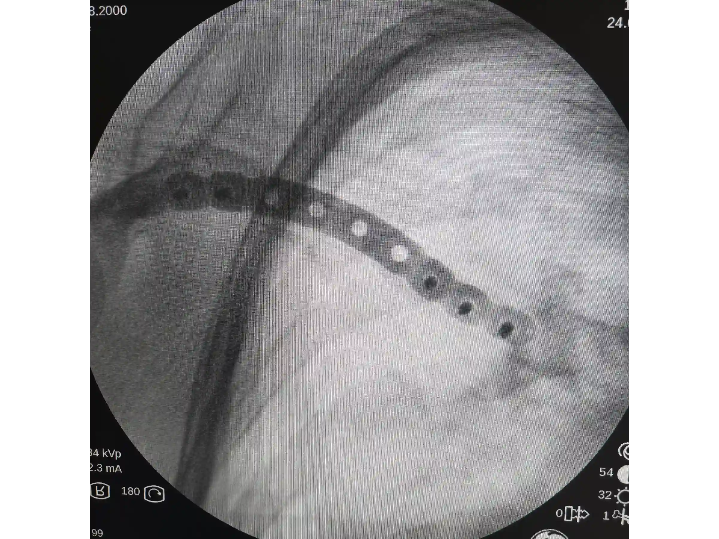 CLAVICLE [CASE 03] Minimally Invasive Percutaneous Osteosynthesis
