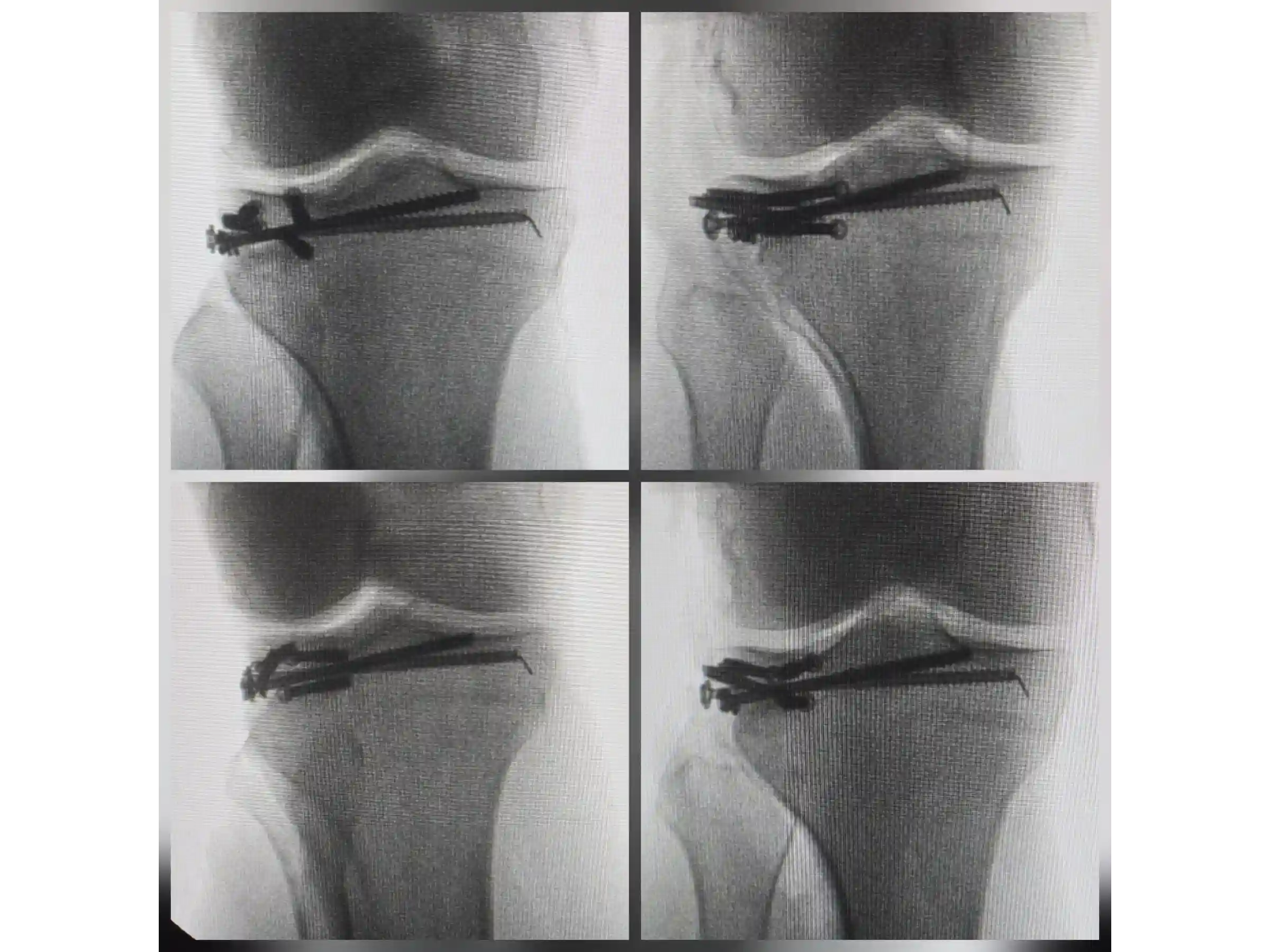 TIBIAL PLATEAU [CASE 03] Posterolateral Depression