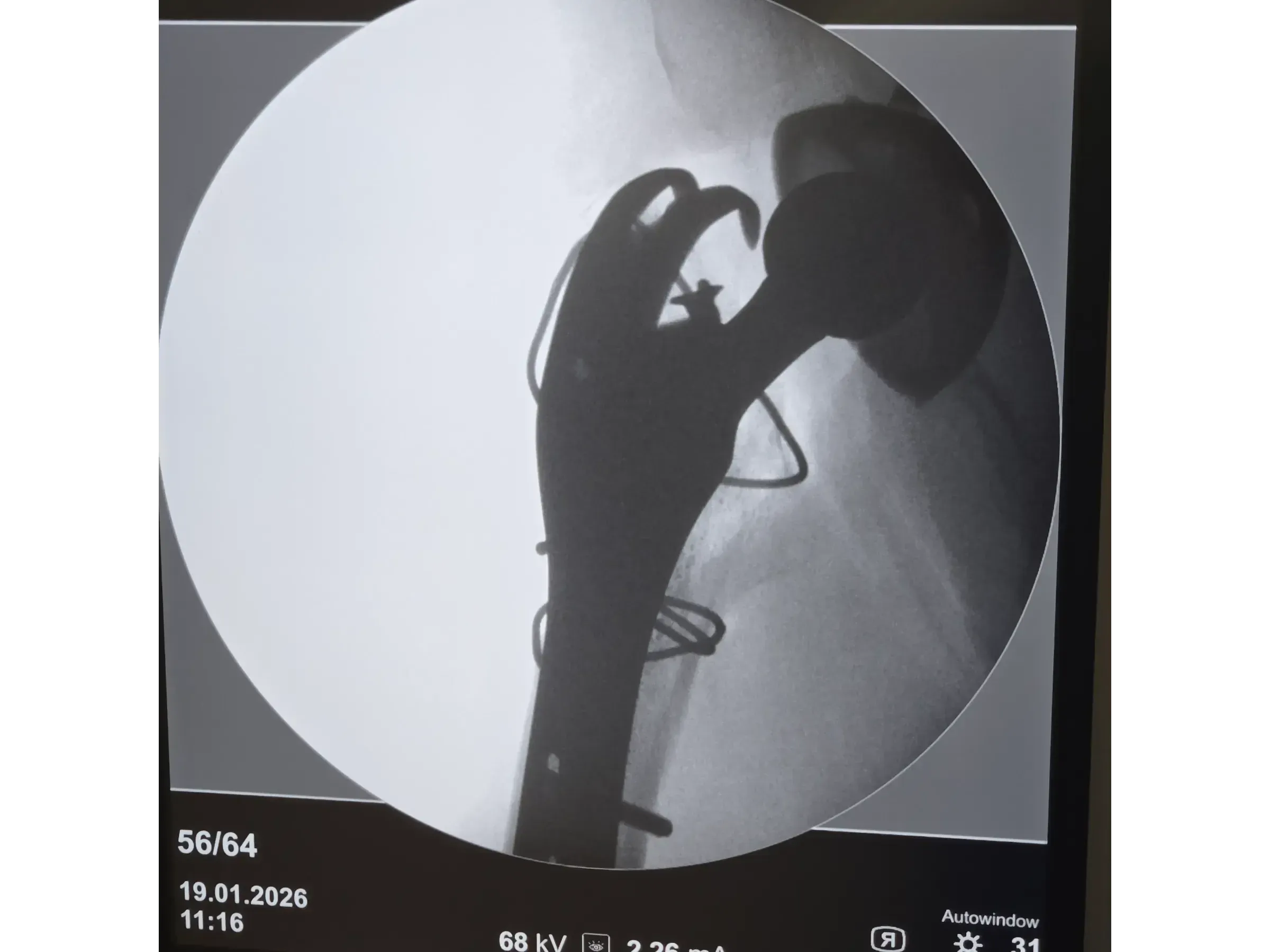 PERIPROSTHETIC HIP FRACTURE [Case 1] · Trochanteric Plate + Cerclage