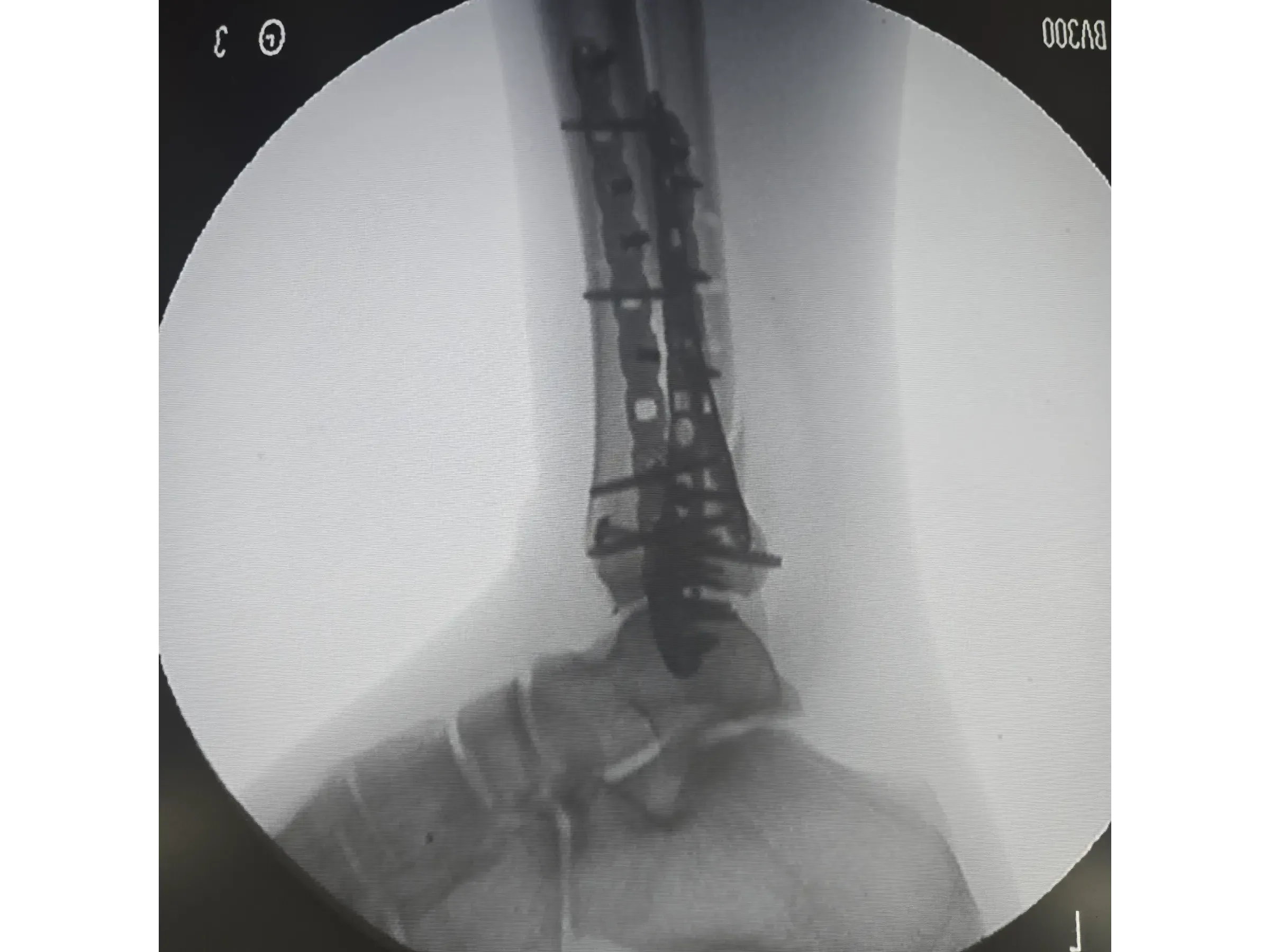 TIBIAL PILON [Case 2] · Posteromedial + Lateral Approach