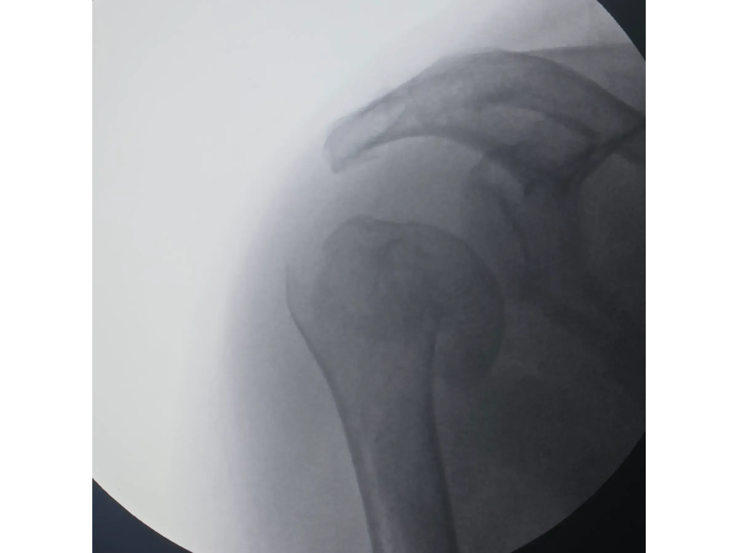 PROXIMAL HUMERUS [Case 6] · Two-Part Fracture · Plate and Screws