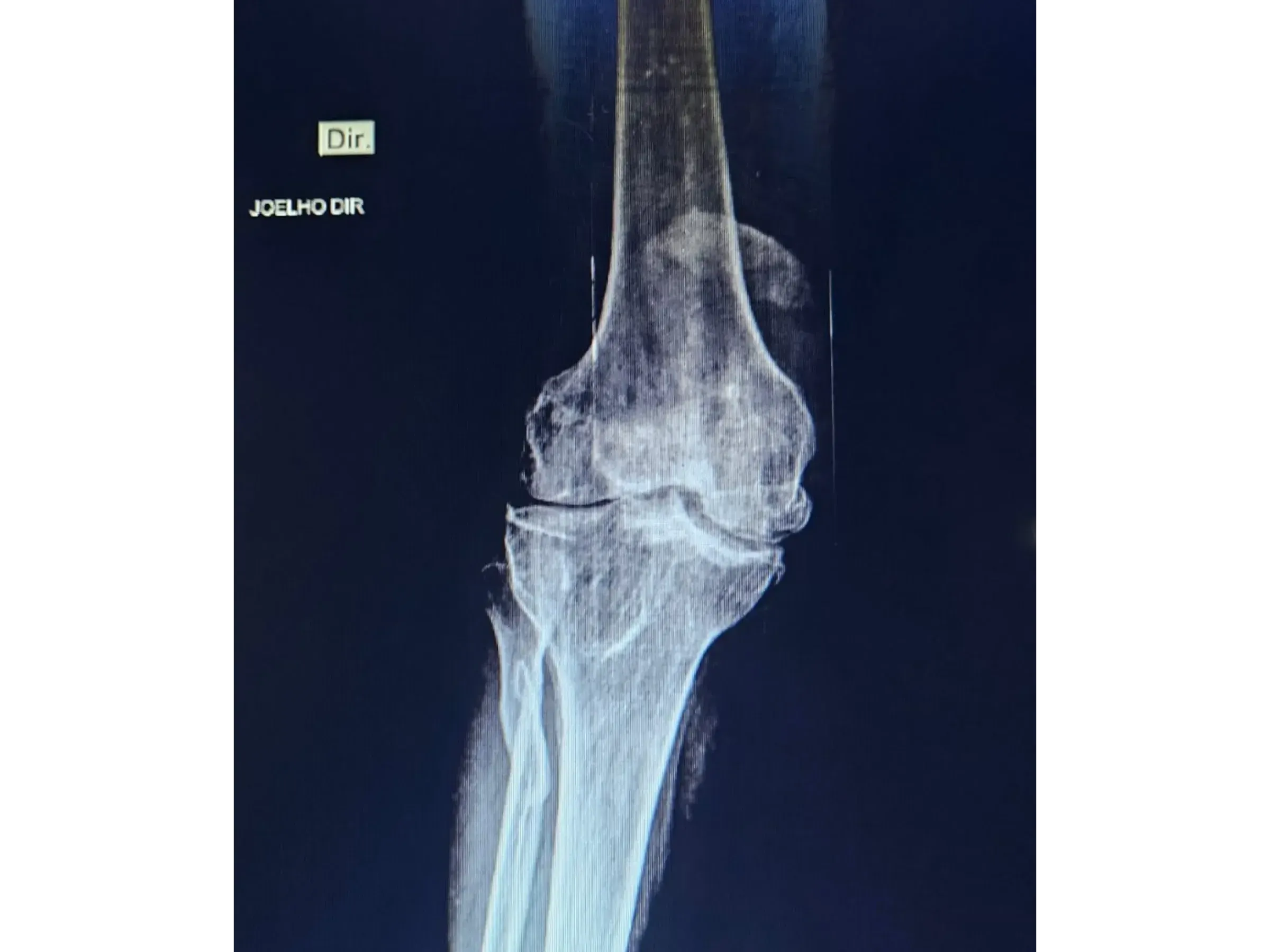PATELLA [Case 2] · Cannulated Screws + Cerclage