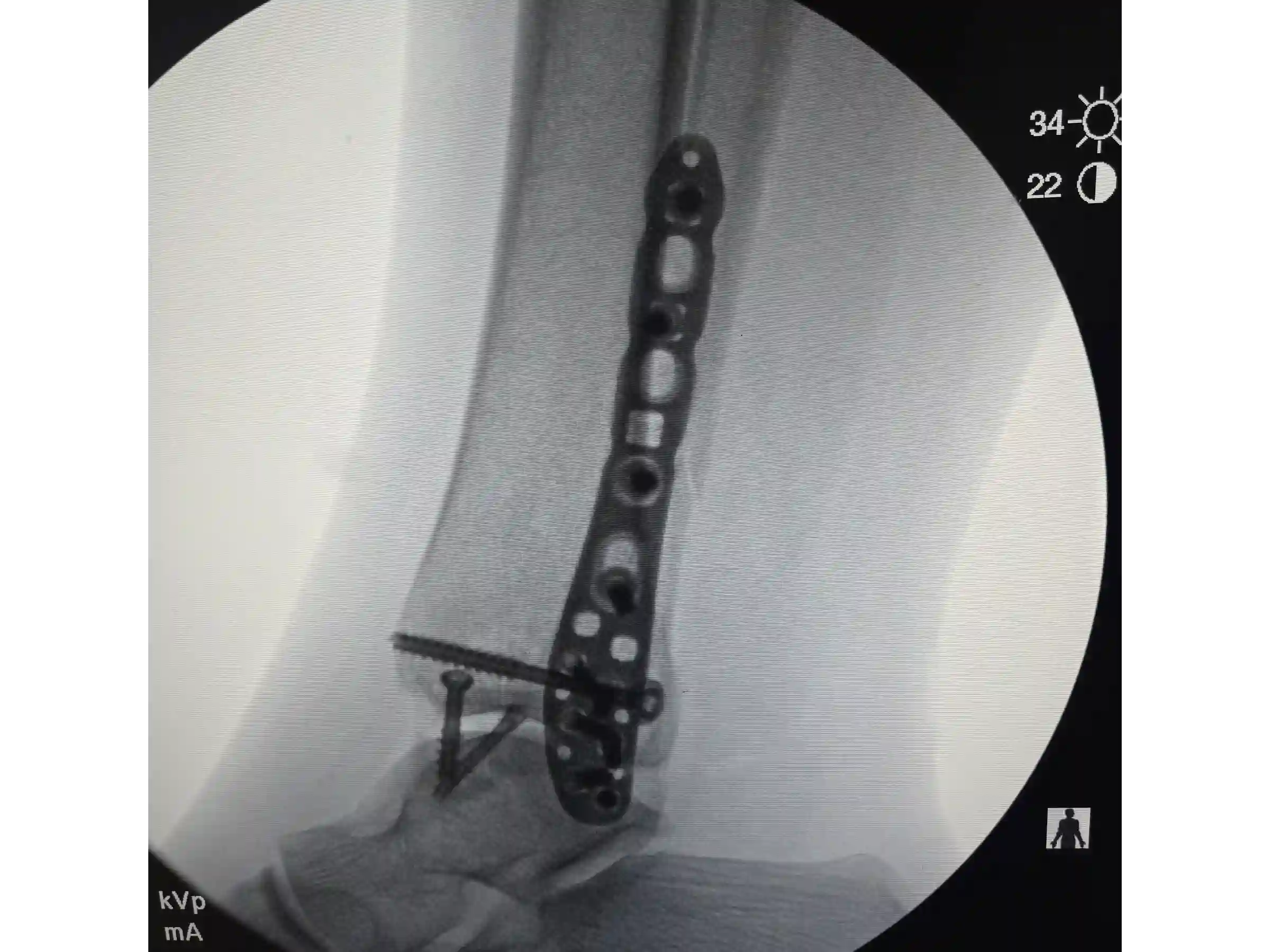 TRIMALLEOLAR [CASE 03] POSTEROLATERAL APPROACH + ANTEGRADE MEDIAL MALLEOLUS FIXATION