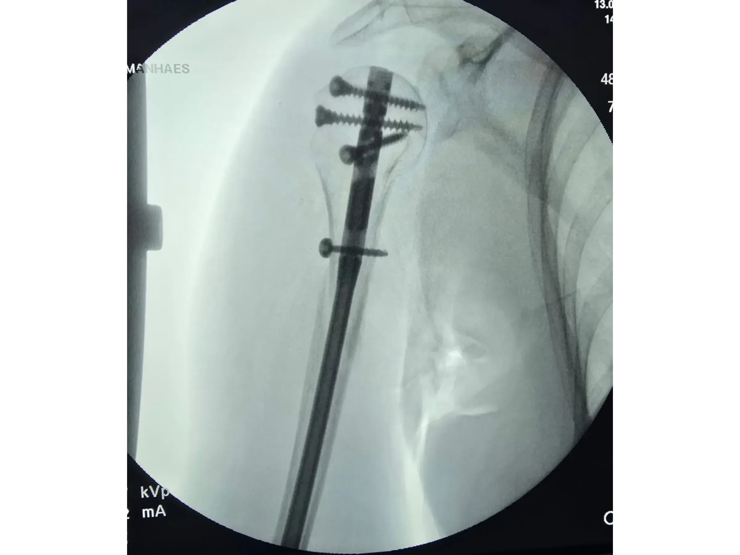 Intramedullärer Nagel für den proximalen Humerus (03)