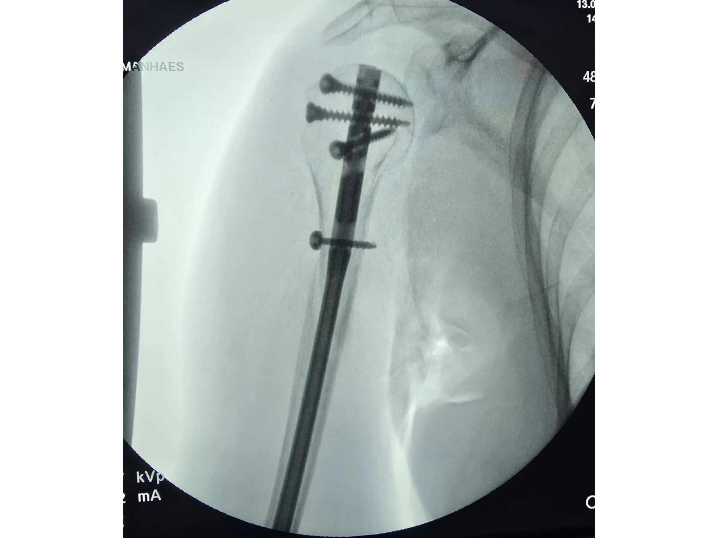 Intramedullärer Nagel für den proximalen Humerus