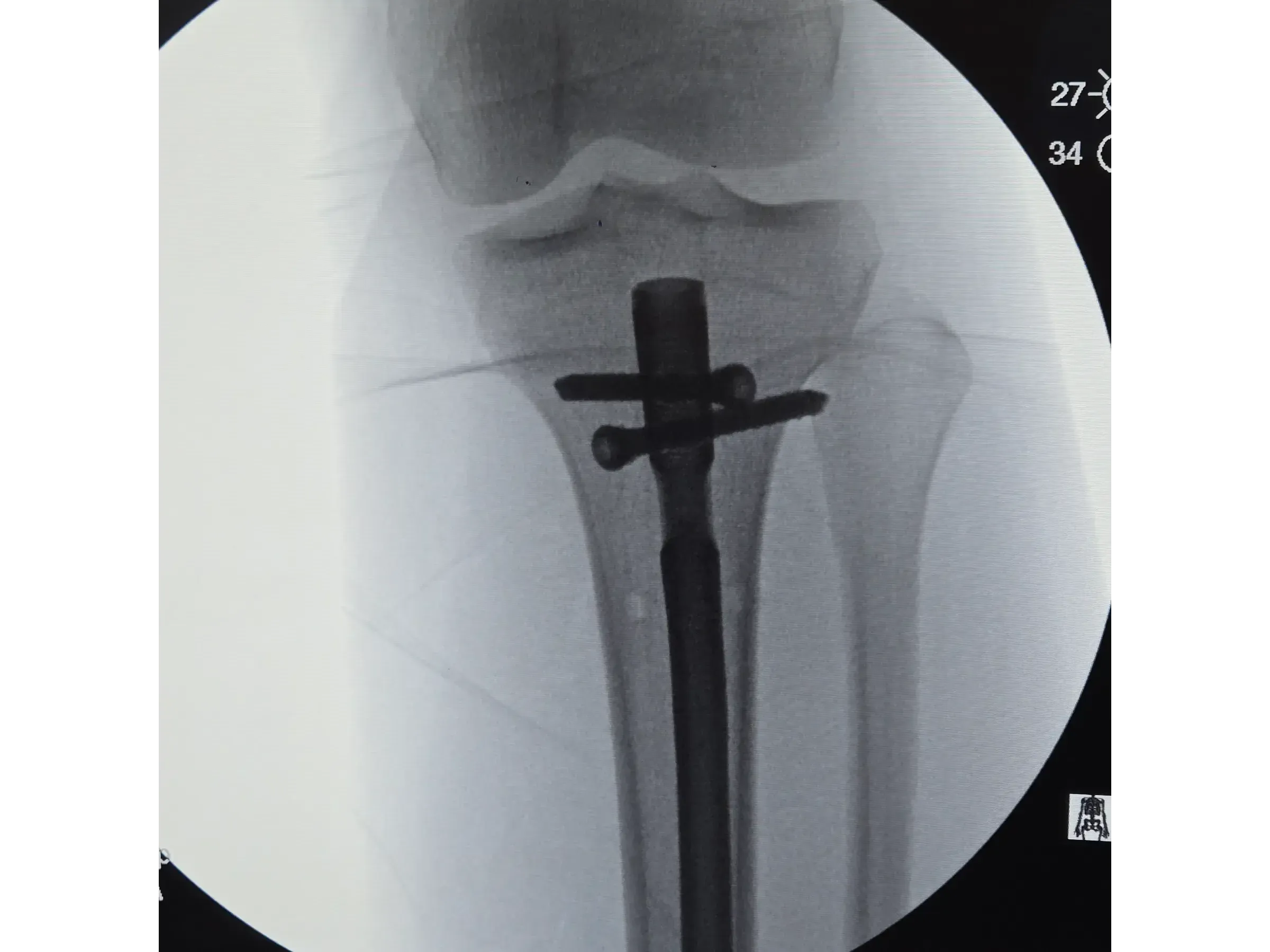 Intramedulläre Tibianagelung – Infrapatellarer Zugang