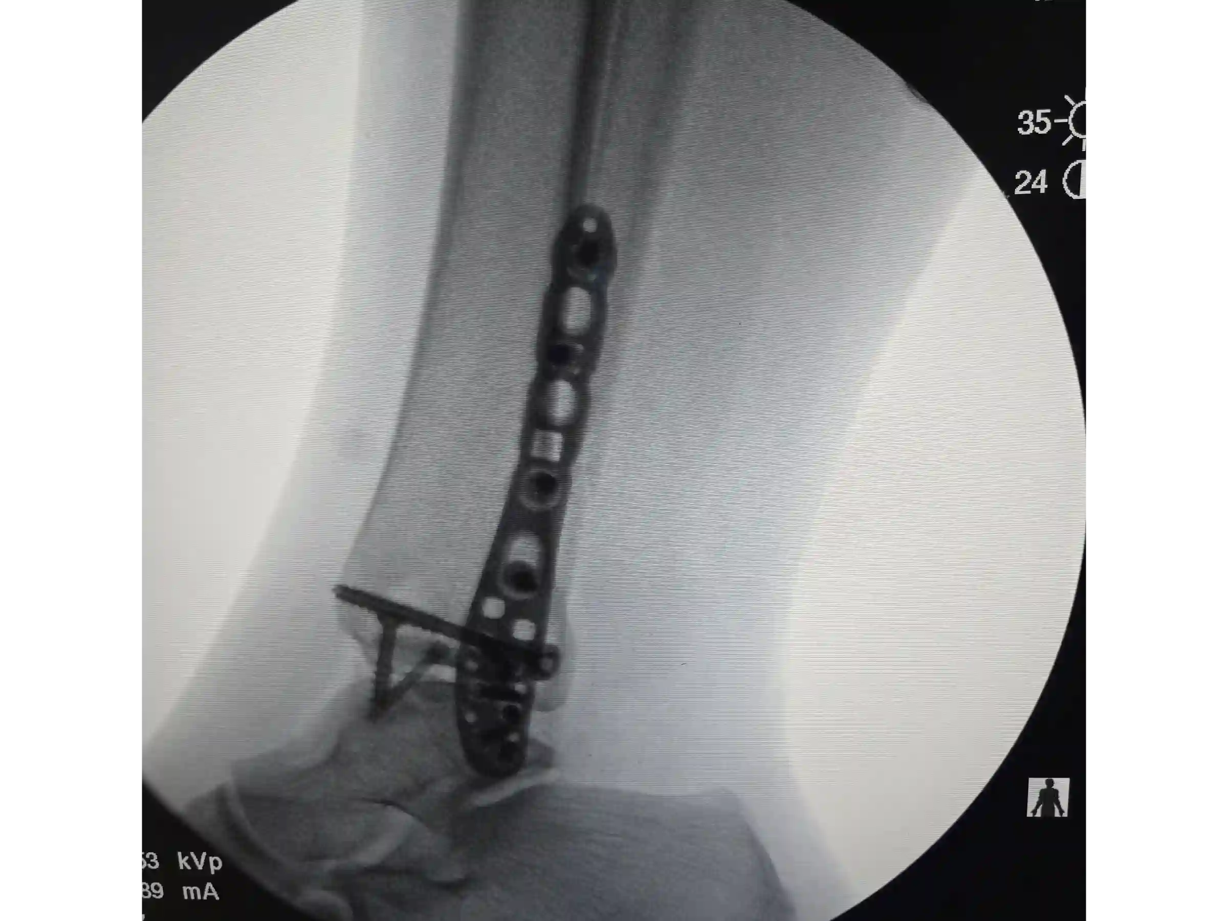 TRIMALLEOLAR [CASE 03] POSTEROLATERAL APPROACH + ANTEGRADE MEDIAL MALLEOLUS FIXATION