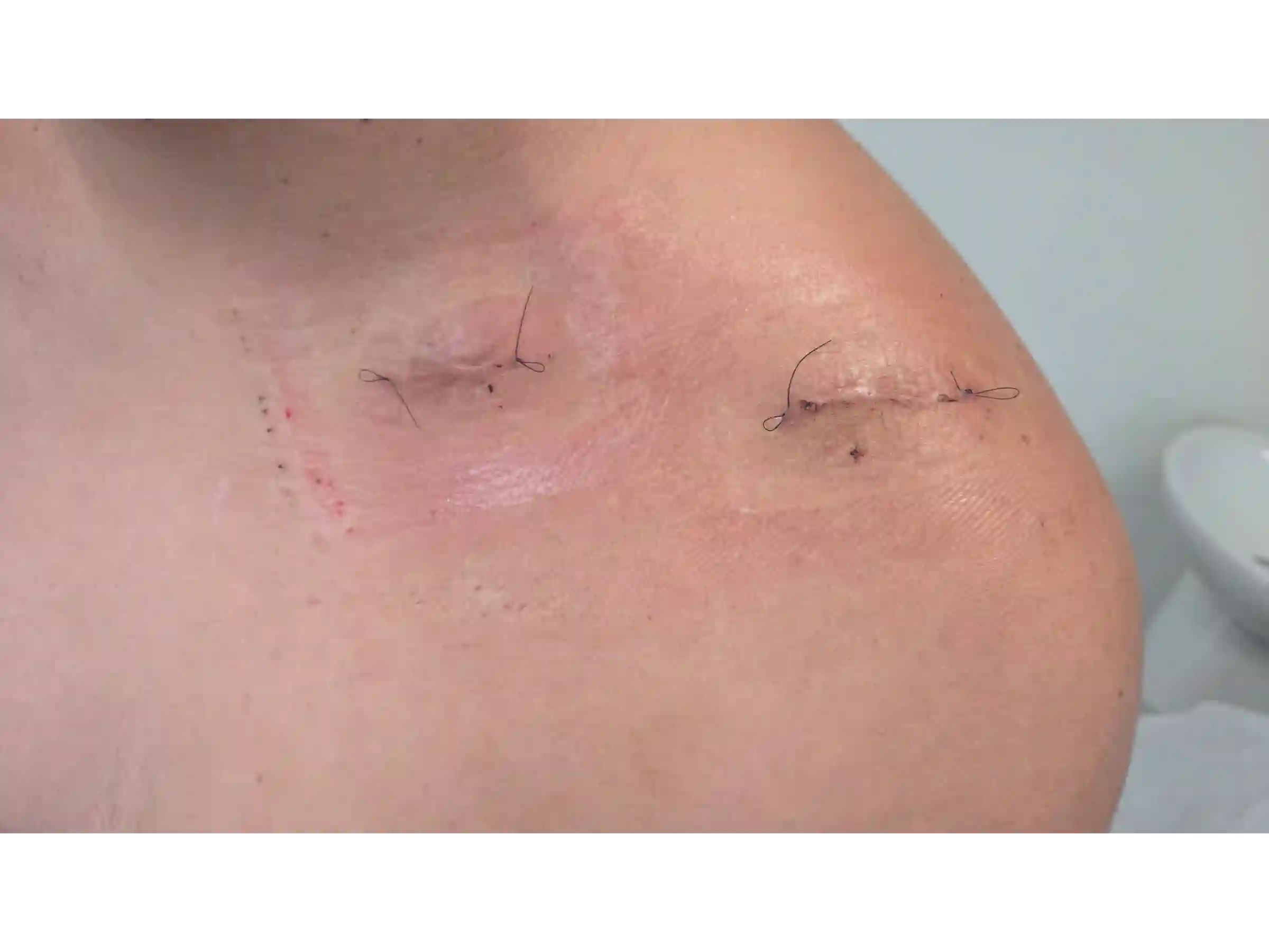 CLAVICLE [CASE 03] Minimally Invasive Percutaneous Osteosynthesis