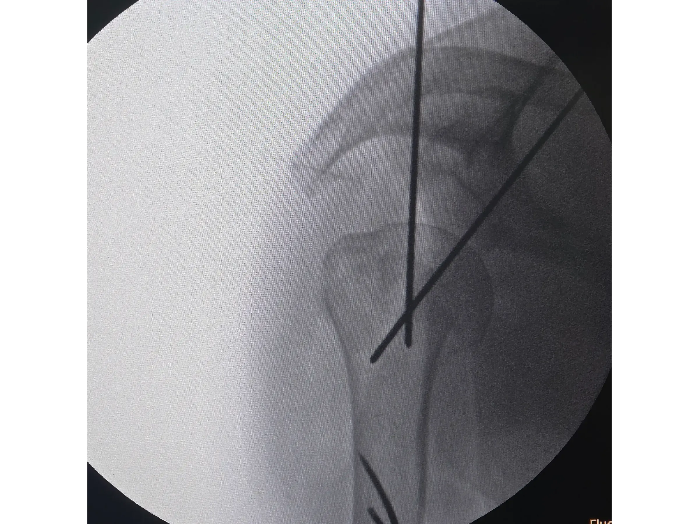 PROXIMAL HUMERUS [Case 6] · Two-Part Fracture · Plate and Screws