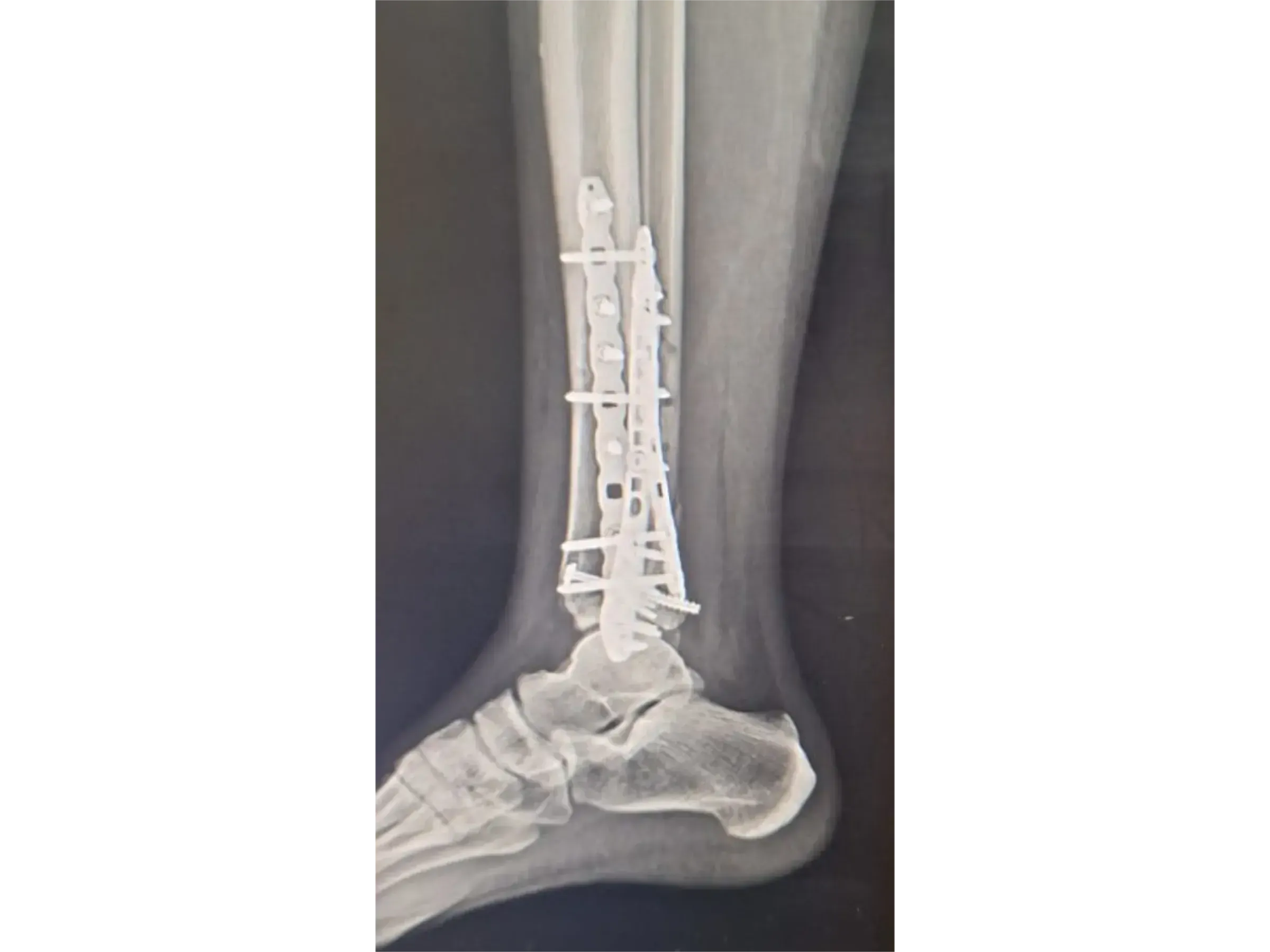 TIBIAL PILON [Case 2] · Posteromedial + Lateral Approach