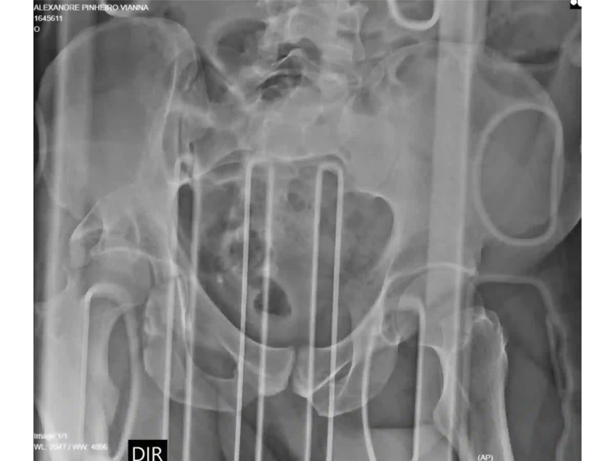 ACETABULUM [FALL 02] · Hinterer Rand + Gelenkimpaktion