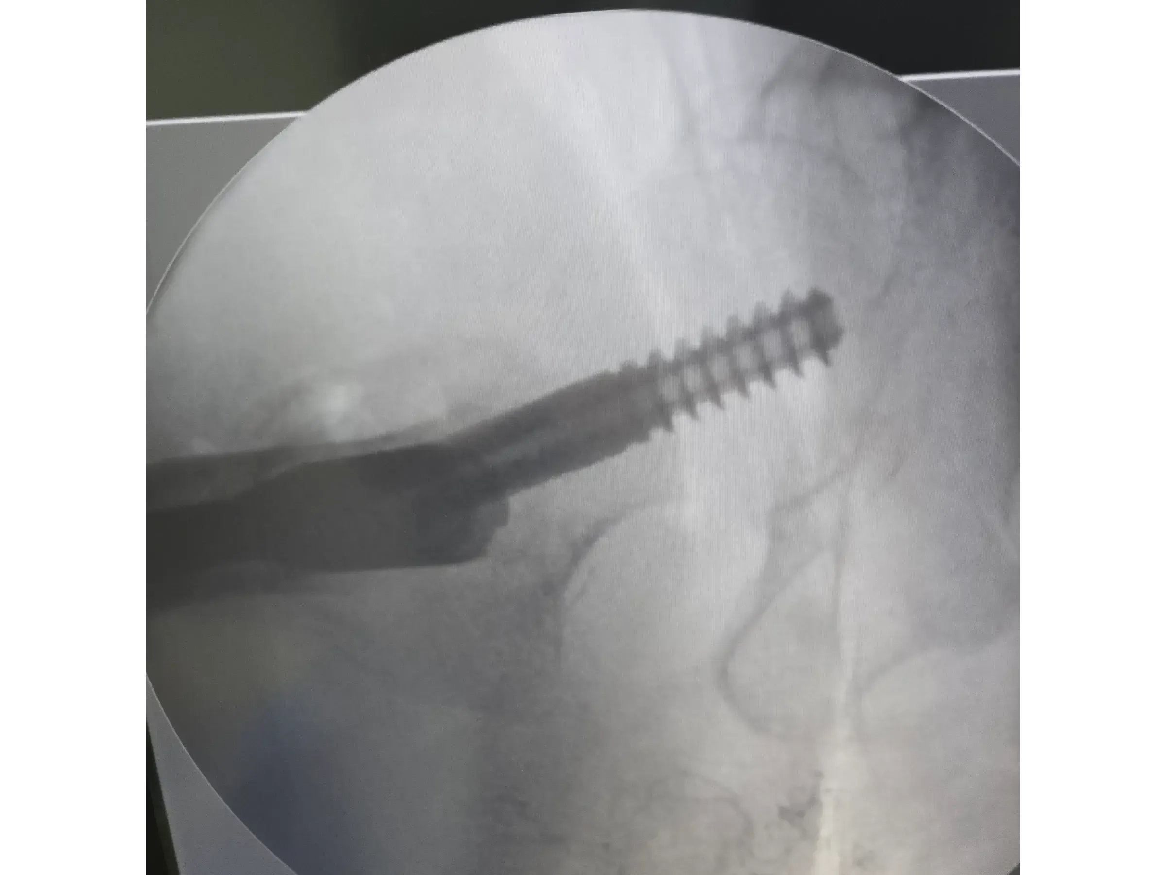 Intramedullärer Nagel für den proximalen Femur 03 – Rocker (Wippen)-Manöver