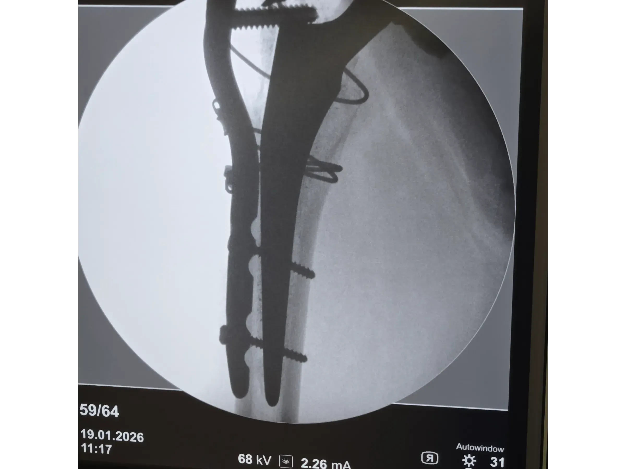 PERIPROSTHETIC HIP FRACTURE [Case 1] · Trochanteric Plate + Cerclage