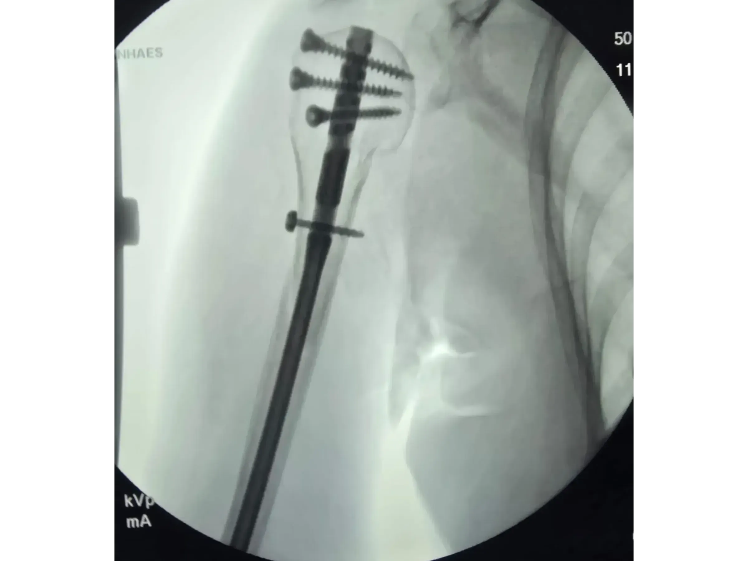 Intramedullärer Nagel für den proximalen Humerus (03)
