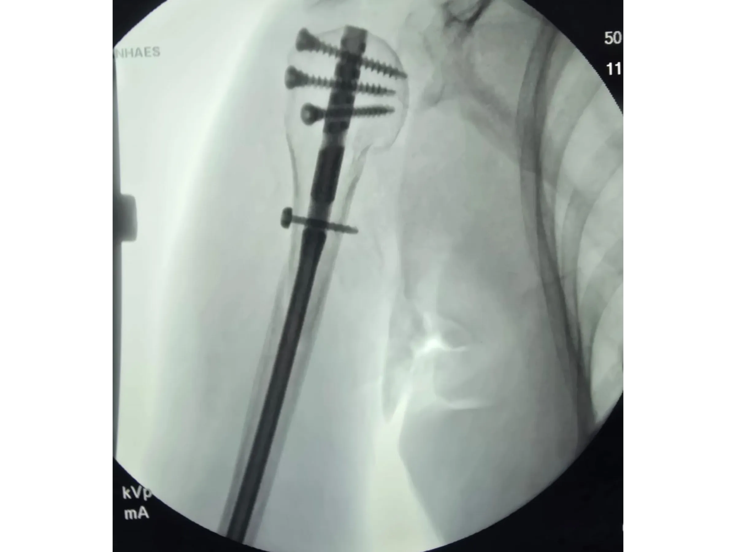 Intramedullärer Nagel für den proximalen Humerus