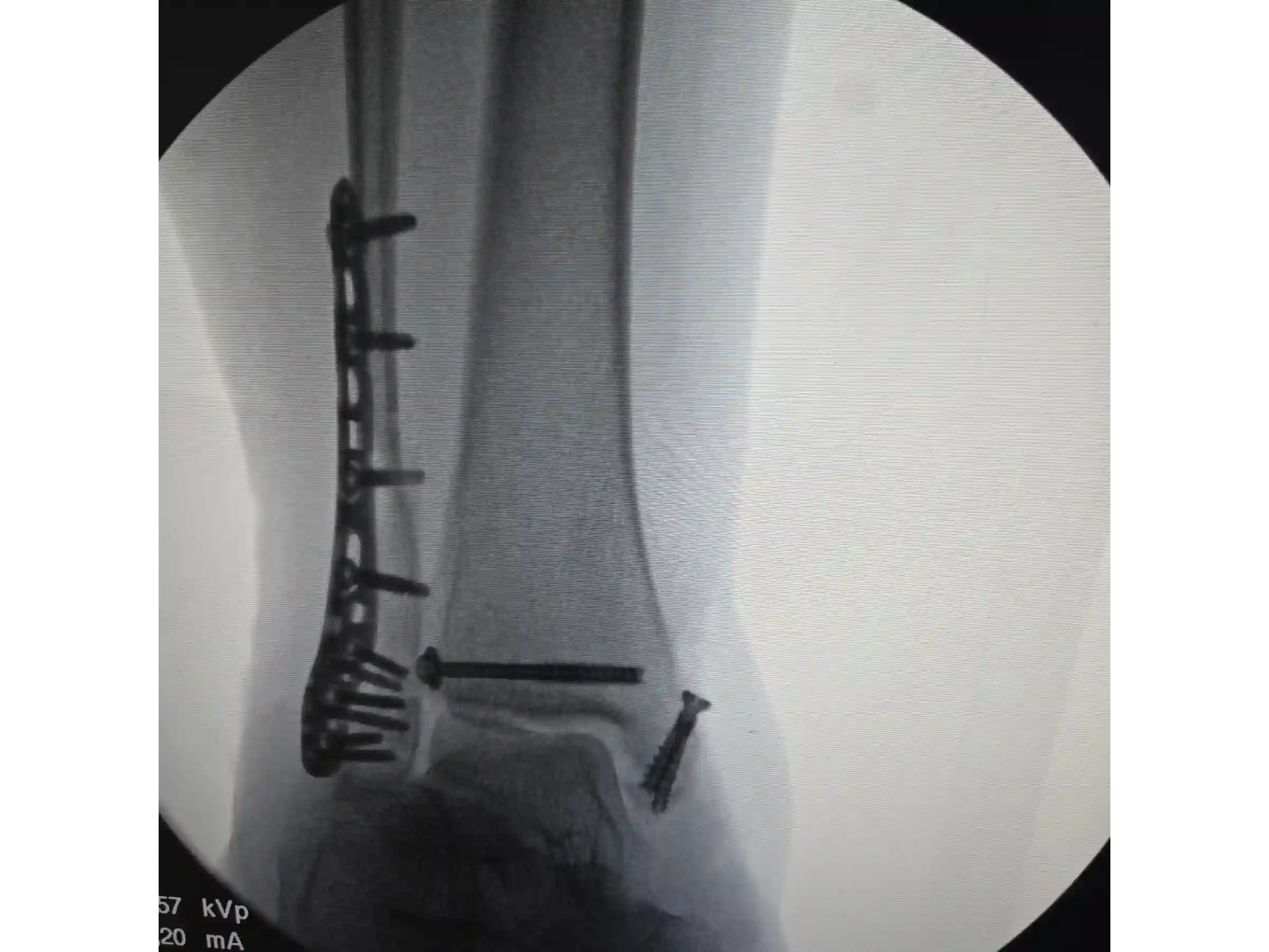 TRIMALLEOLAR [CASE 03] POSTEROLATERAL APPROACH + ANTEGRADE MEDIAL MALLEOLUS FIXATION