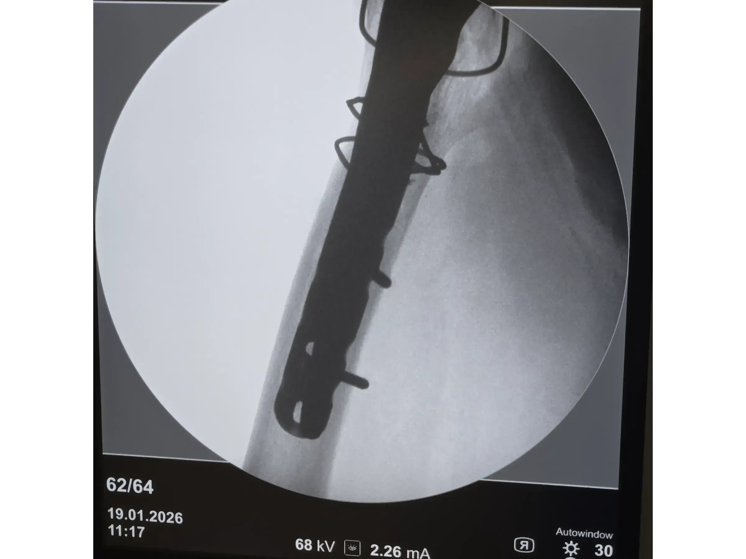 PERIPROSTHETIC HIP FRACTURE [Case 1] · Trochanteric Plate + Cerclage