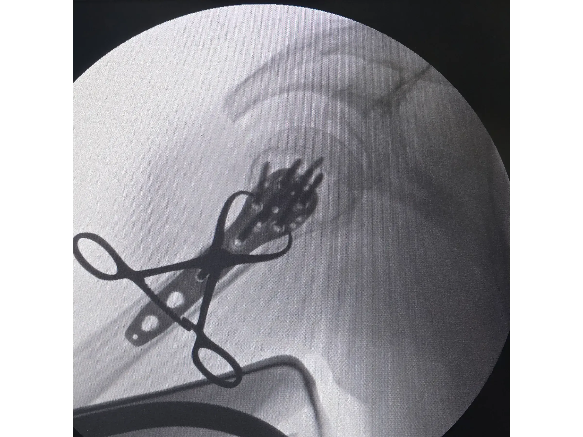 PROXIMAL HUMERUS [Case 6] · Two-Part Fracture · Plate and Screws