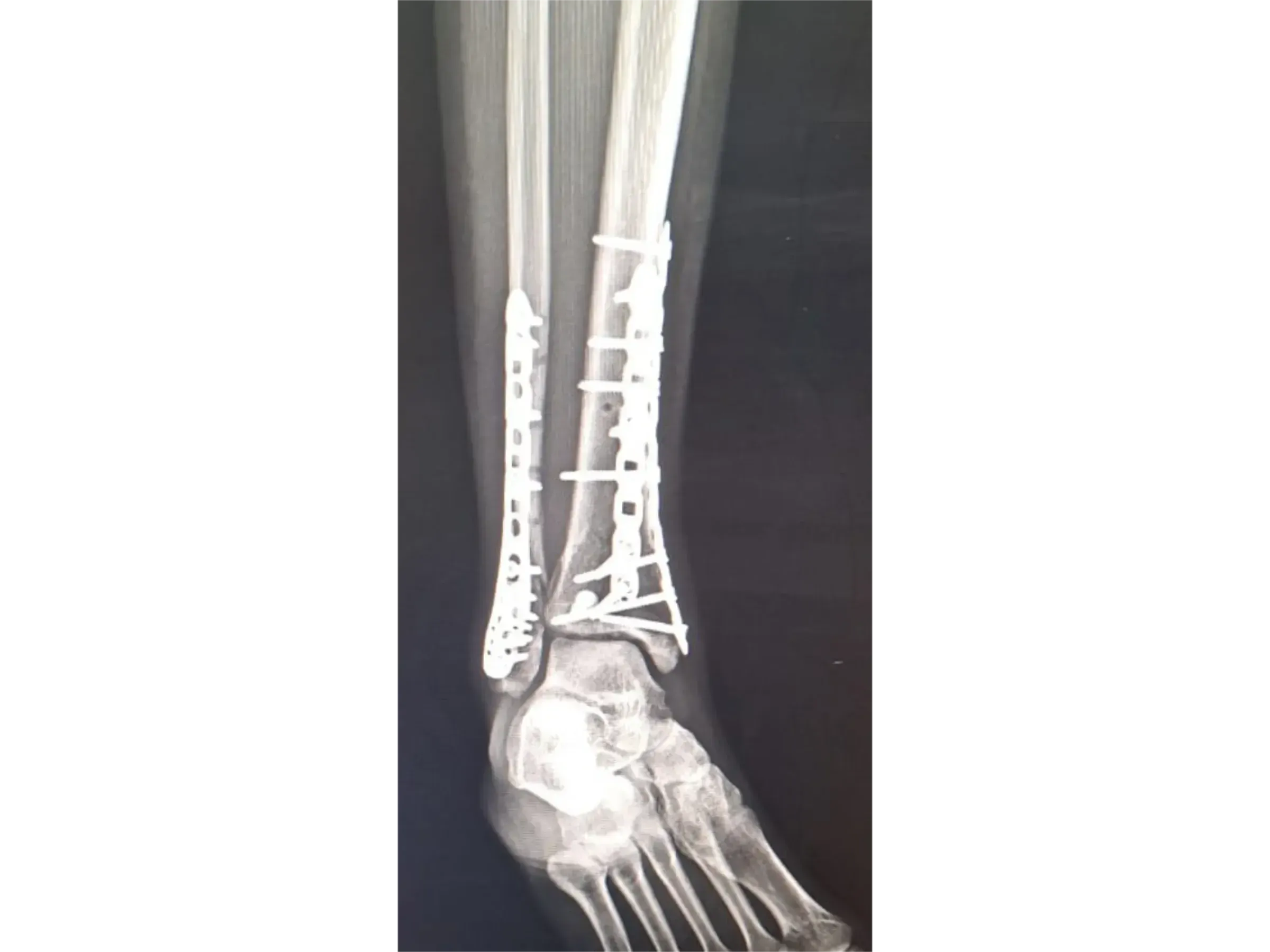 TIBIAL PILON [Case 2] · Posteromedial + Lateral Approach