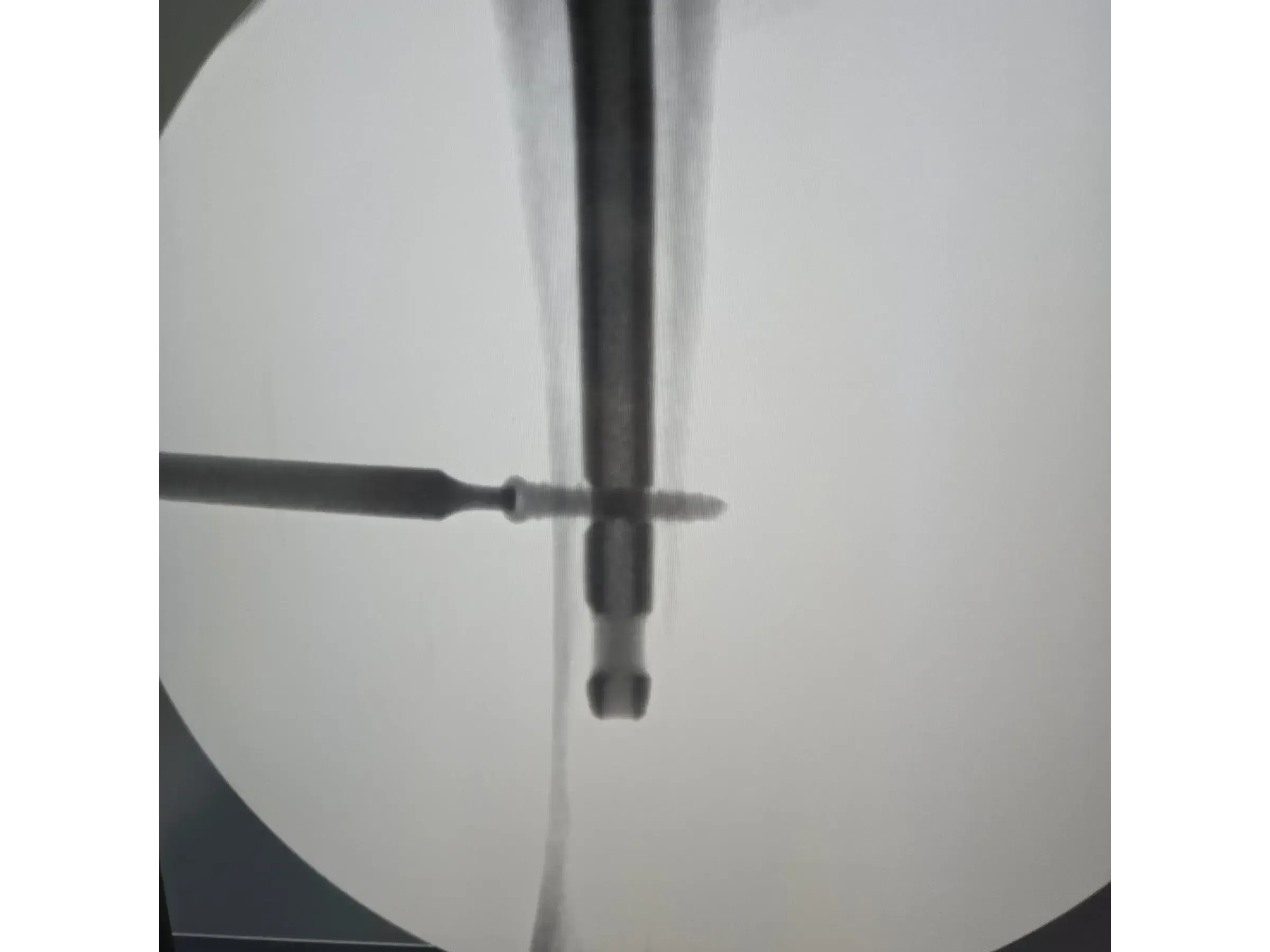 Intramedullärer Nagel für den proximalen Femur 03 – Rocker (Wippen)-Manöver