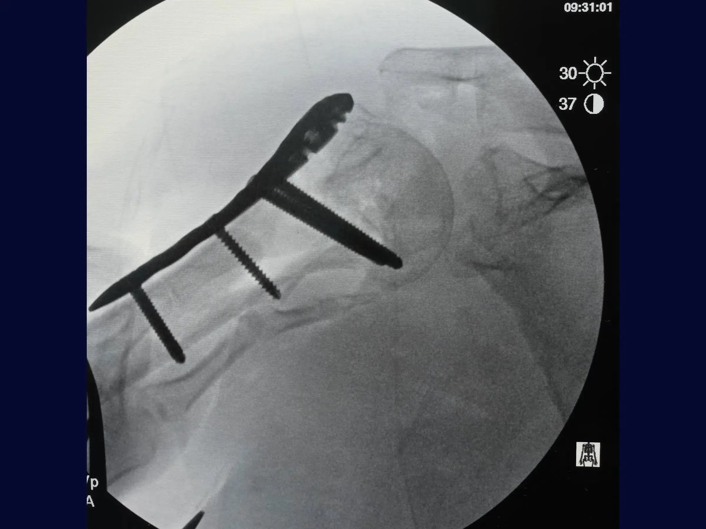 Proximal Humerus – Four-Part Fracture (05)
