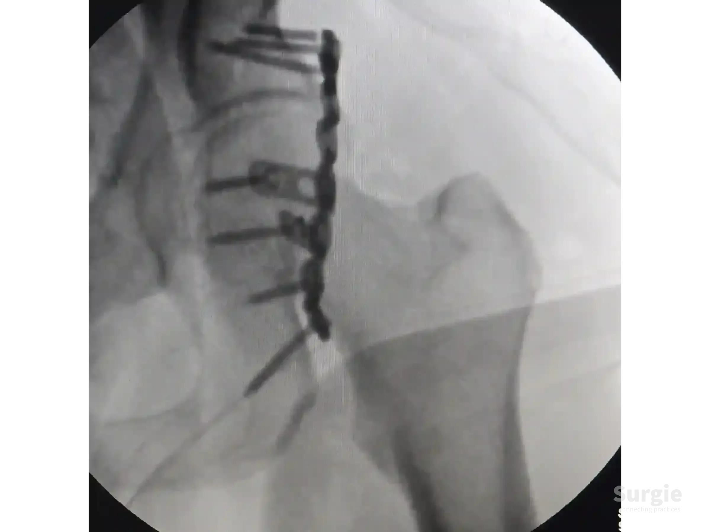 Fluoroscopic view of an acetabular fracture fixed with a contoured posterior column plate and screws.