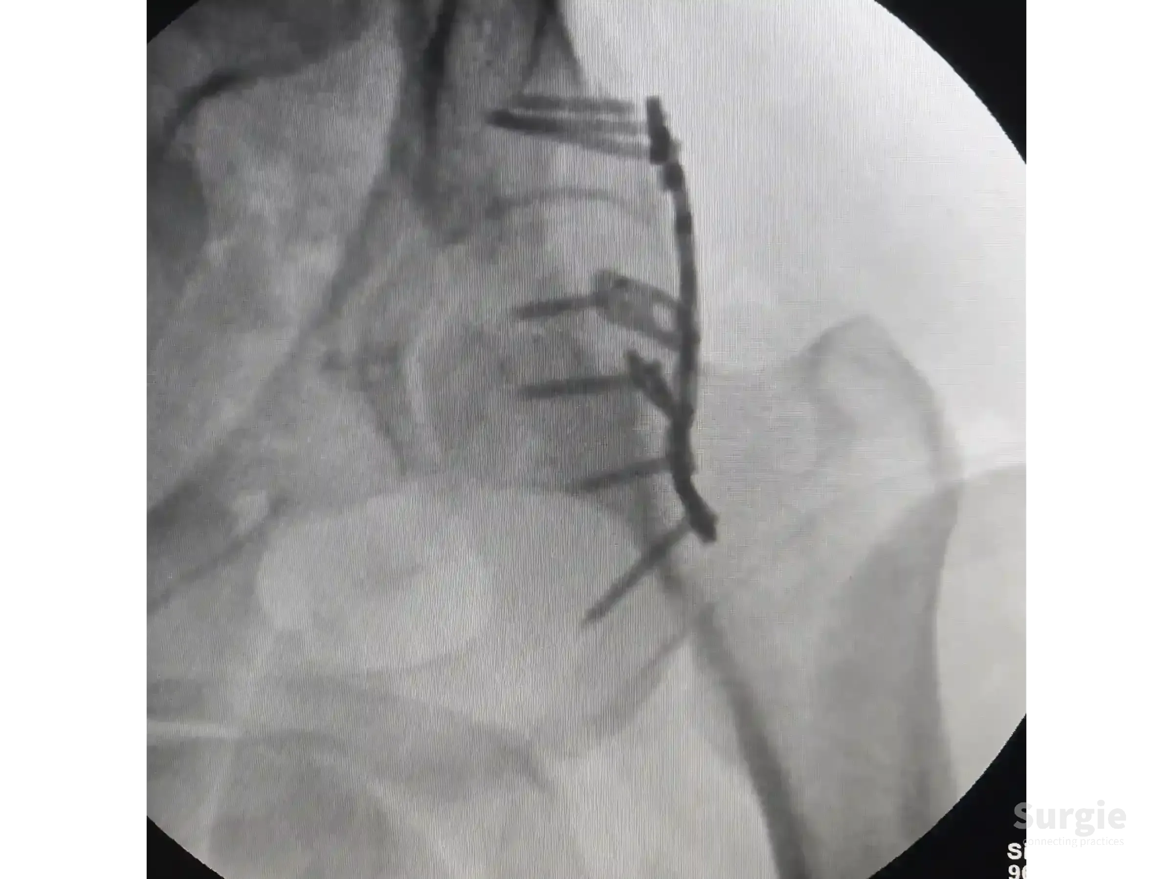 X-ray showing acetabular fracture fixation with a contoured posterior column plate and spring plates.