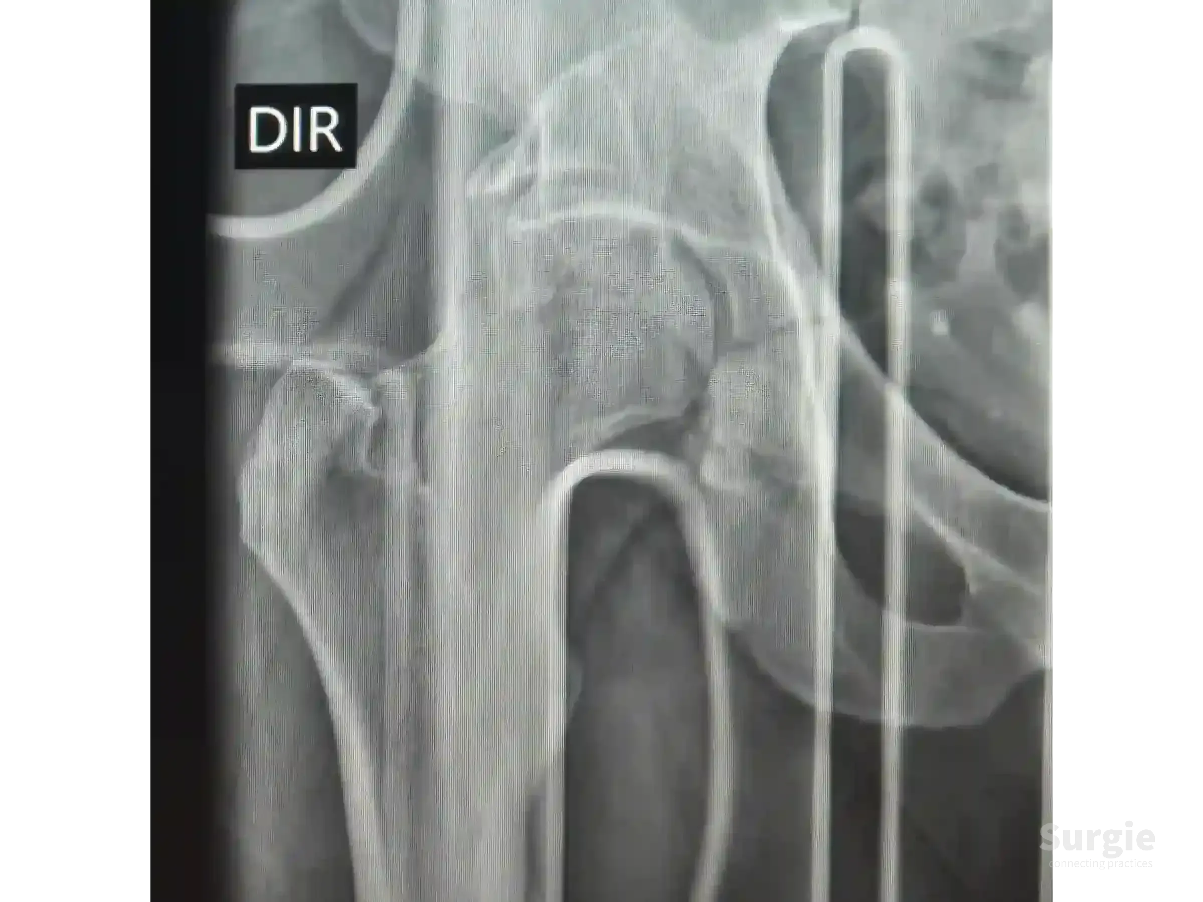 Grayscale X-ray showing a posterior acetabular wall fracture with articular impaction and hip joint dislocation.