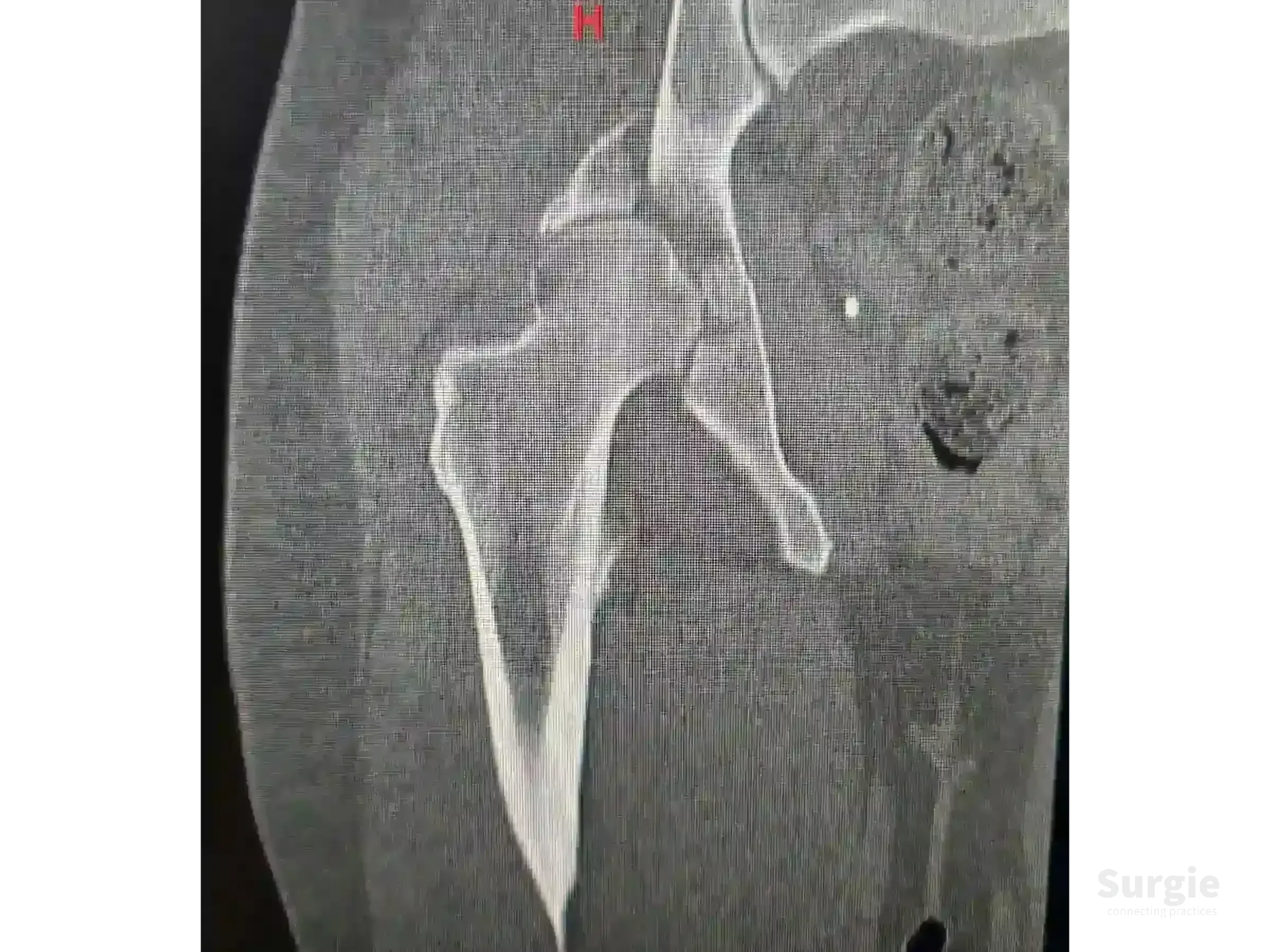 Grayscale CT scan showing a hip fracture-dislocation with posterior acetabular rim impaction and bone fragments.