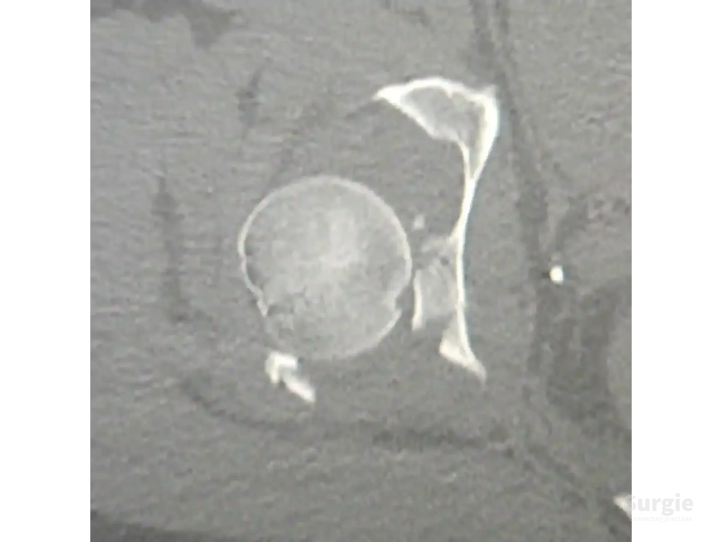 Axial CT scan showing a posterior acetabular wall fracture with articular impaction of the hip joint.
