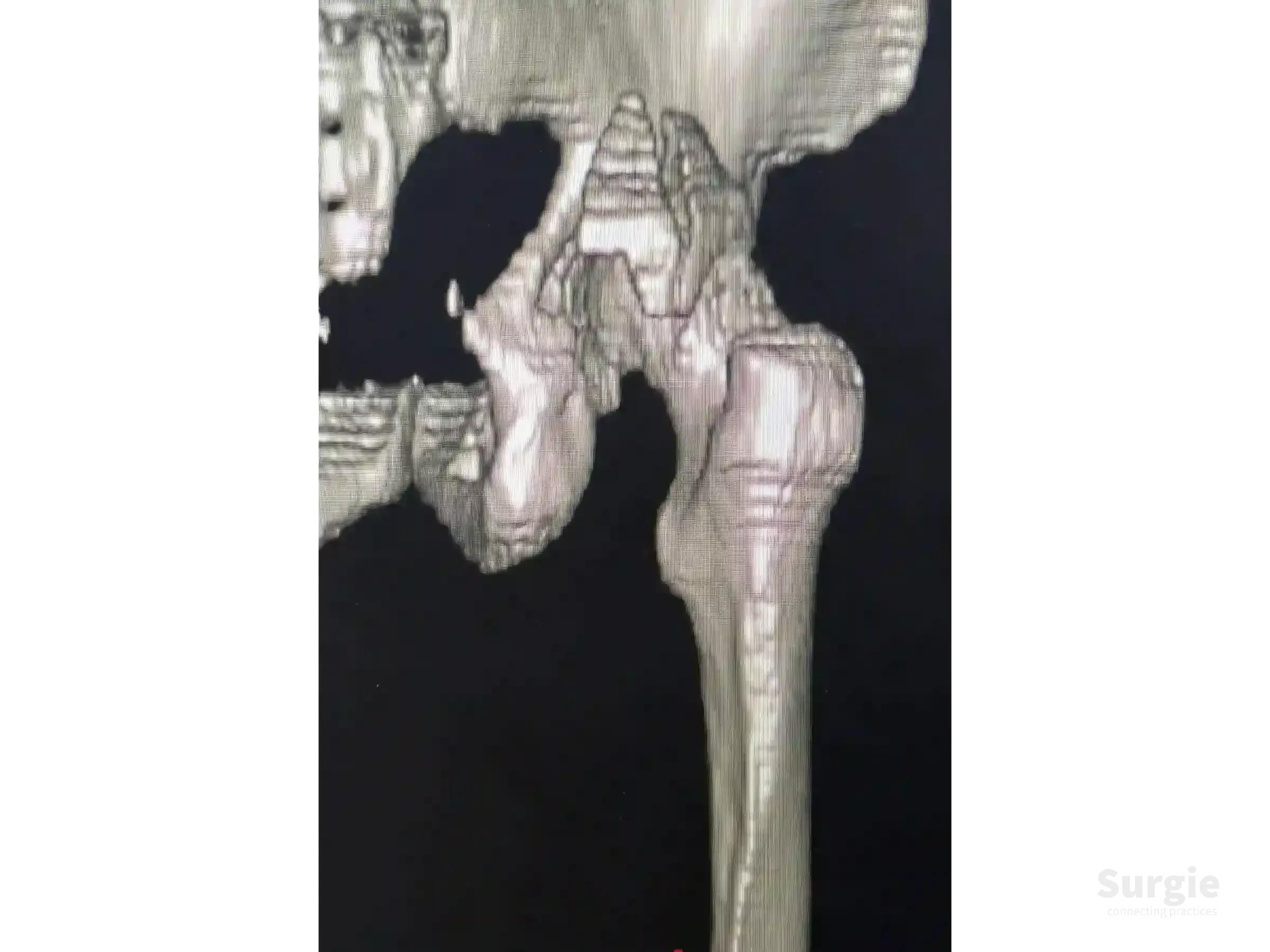 3D CT reconstruction of a hip showing a posterior acetabular wall fracture with articular impaction on a black background.