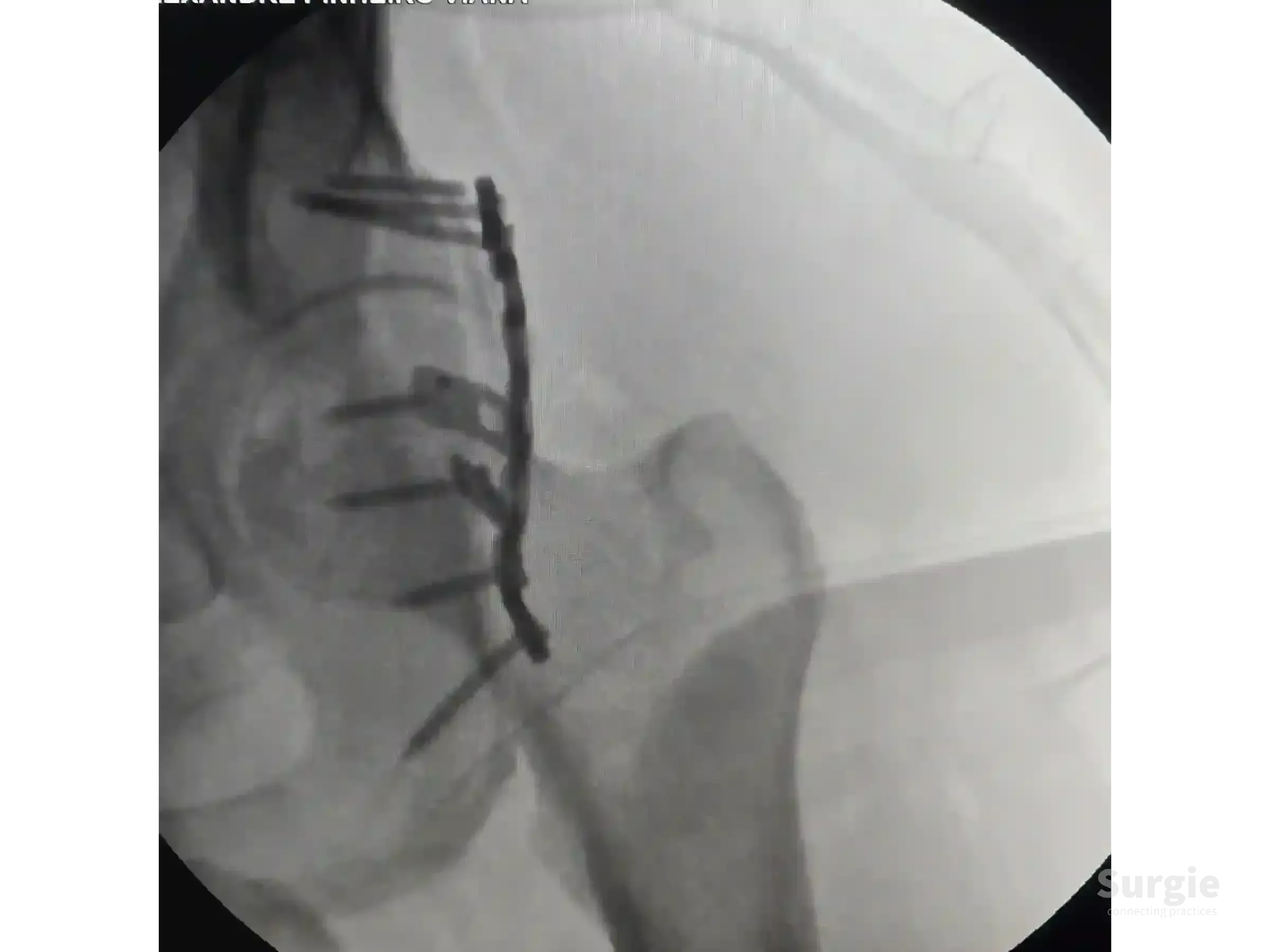 Fluoroscopic view of an acetabular fracture fixed with a contoured posterior column plate and screws.