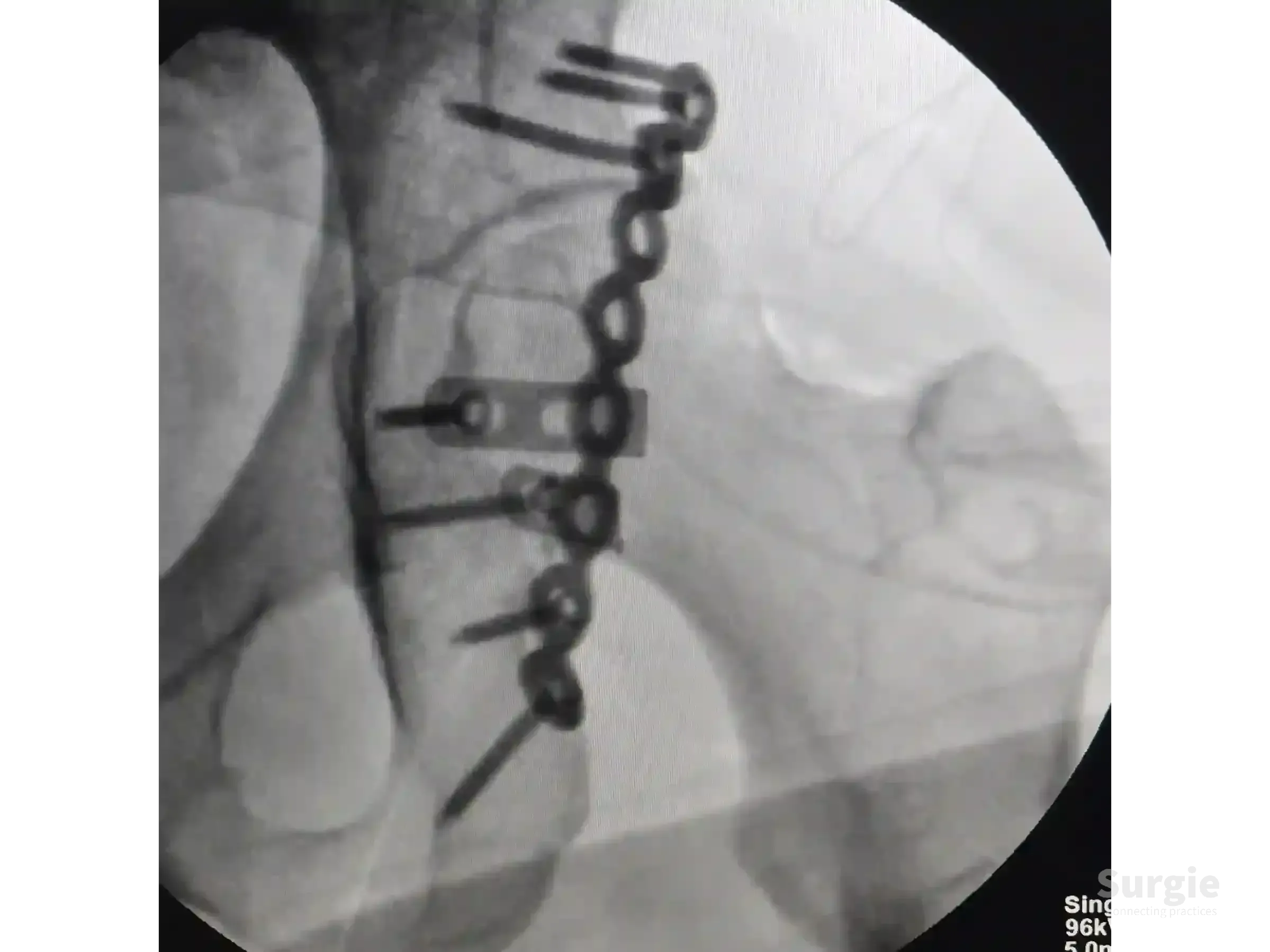 Fluoroscopic view of acetabular fracture fixation using a contoured metal plate and screws on the posterior pelvic rim.