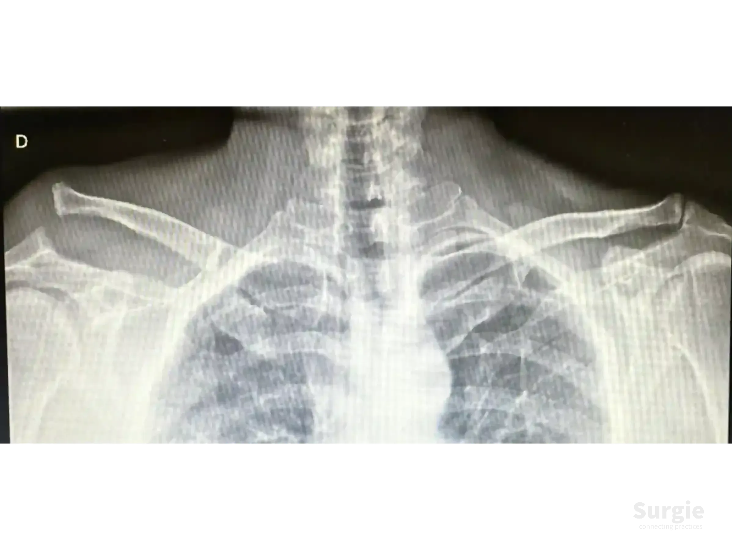 Shoulder X-ray showing acromioclavicular joint dislocation with clavicle elevation and coracoid process anatomy.